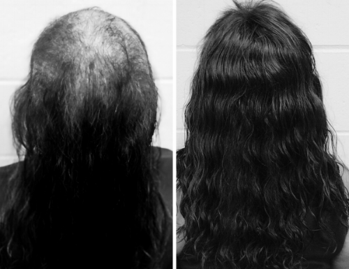 FAQs for Your Non-Surgical Hair Loss Treatment - Mane Solutions — Mane  Solutions
