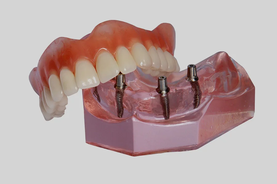 Implant Dentures