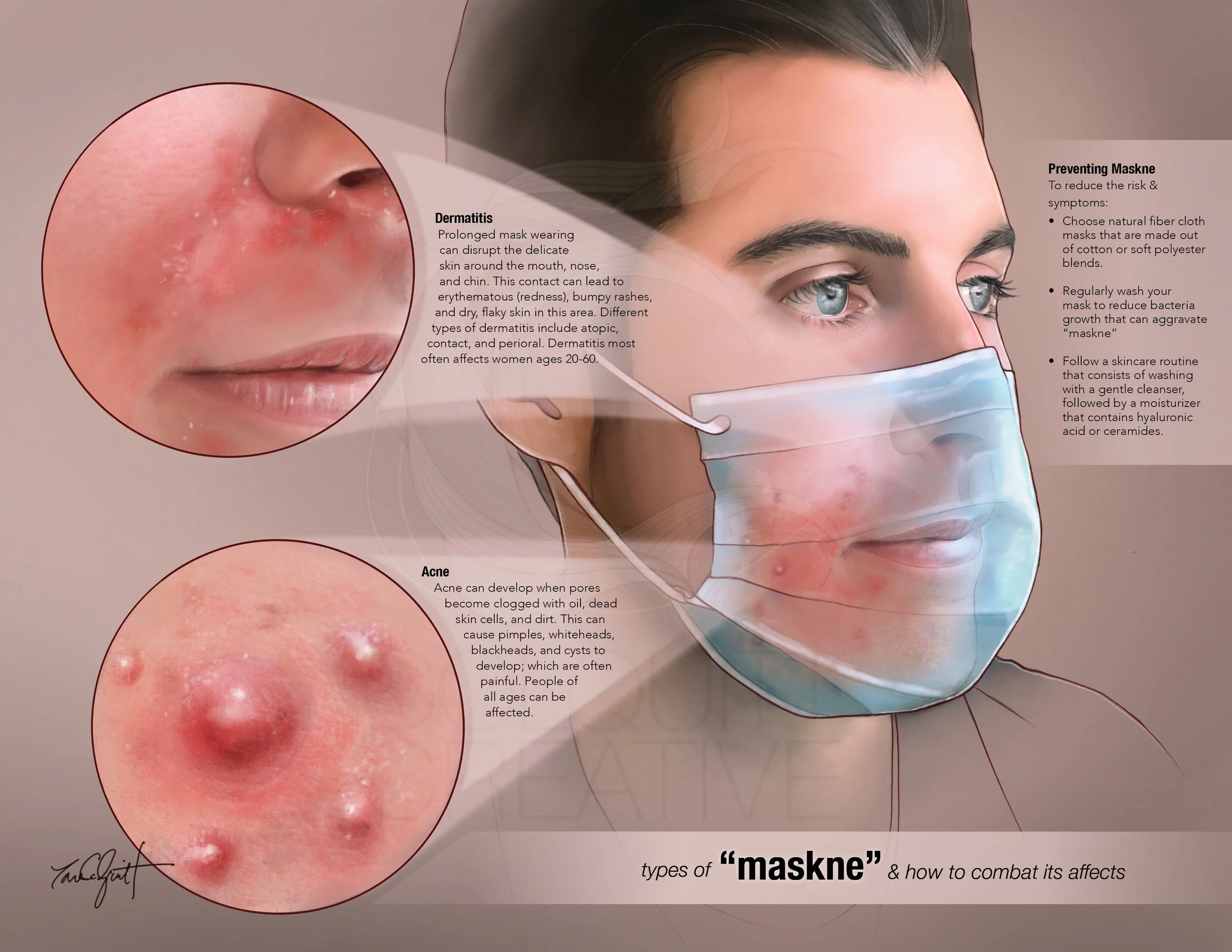 Maskne, What Is It and How To Prevent It
