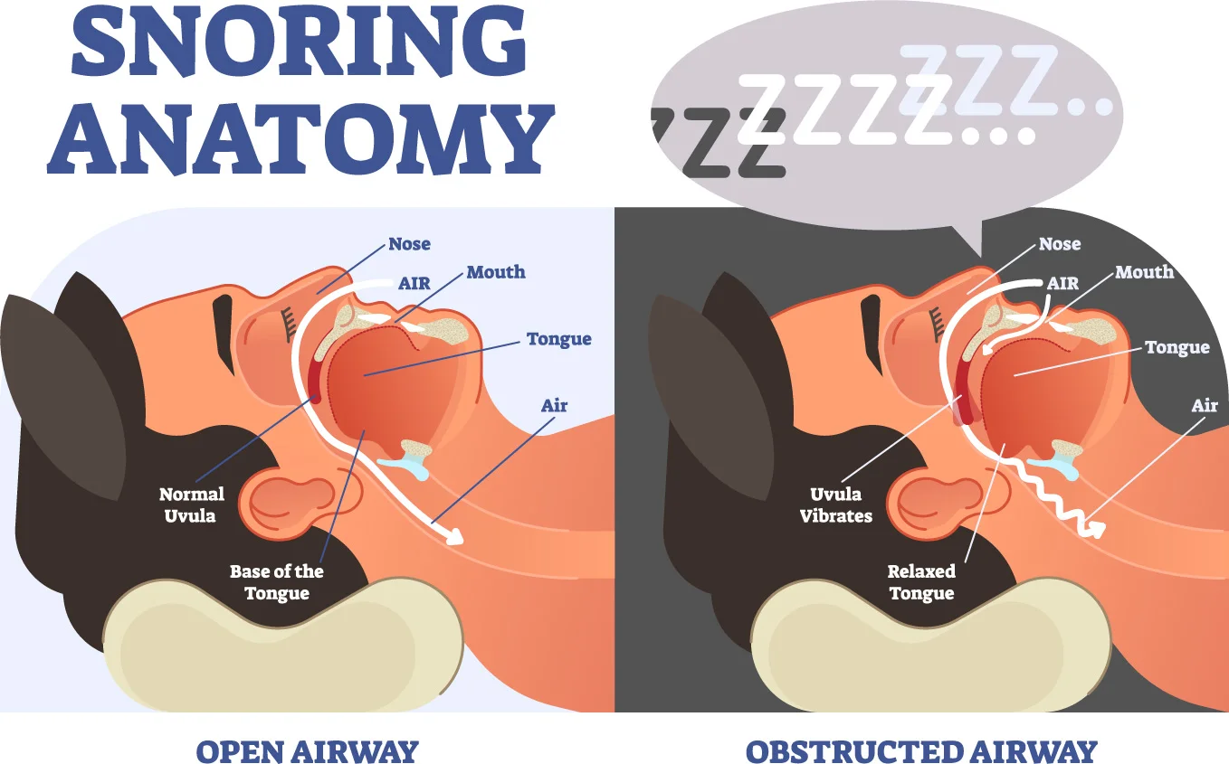 Perfect Anatomy Put A Stop To Snoring Top 7 Practical Tips