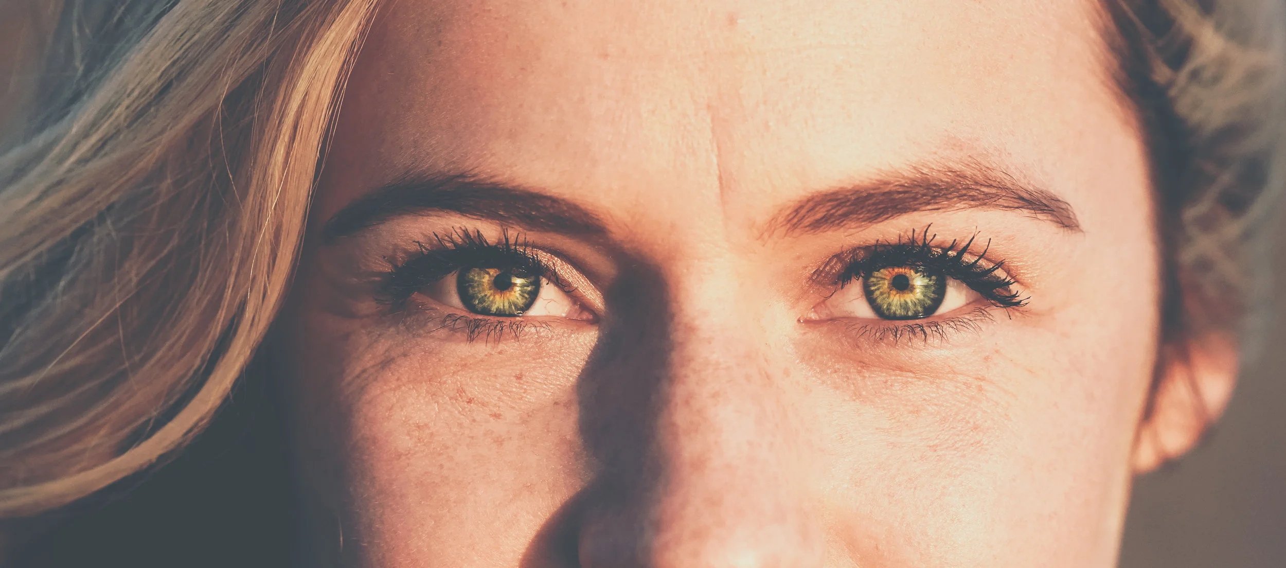 Tear trough treatment with under eye filler in Lexington, MA