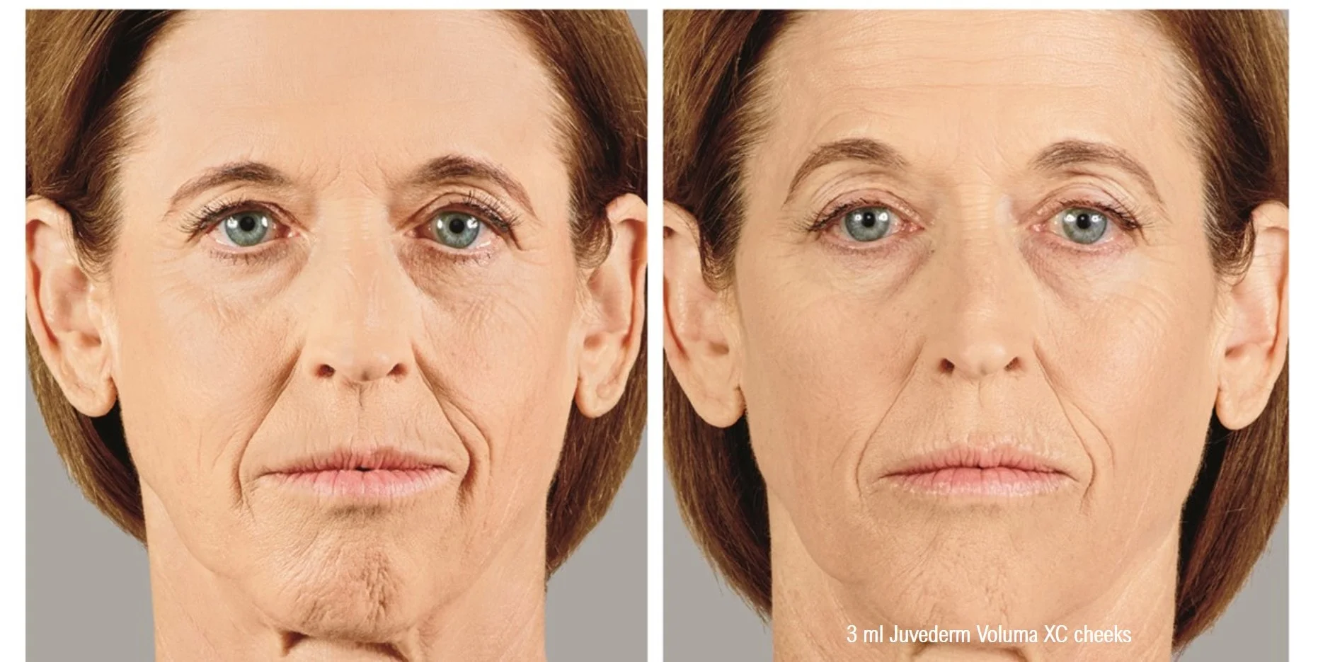 juvederm-voluma-xc-cheek-filler-min.jpg