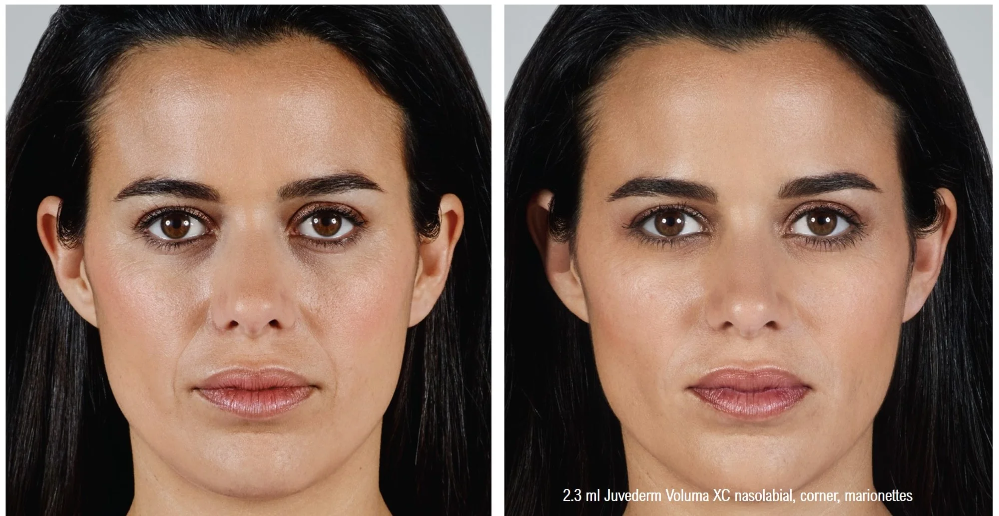 juvederm-voluma-xc-nasolabial-marionettes-filler-min.jpg