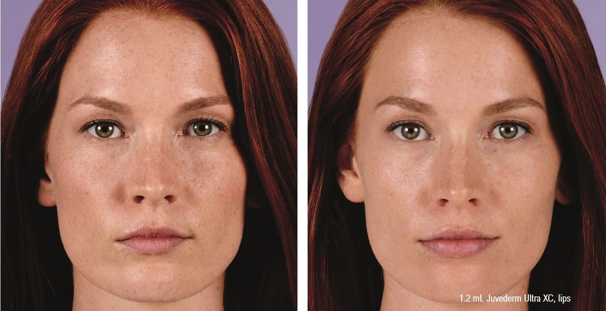 juvederm-ultra-xc-lip-filler-min.jpg