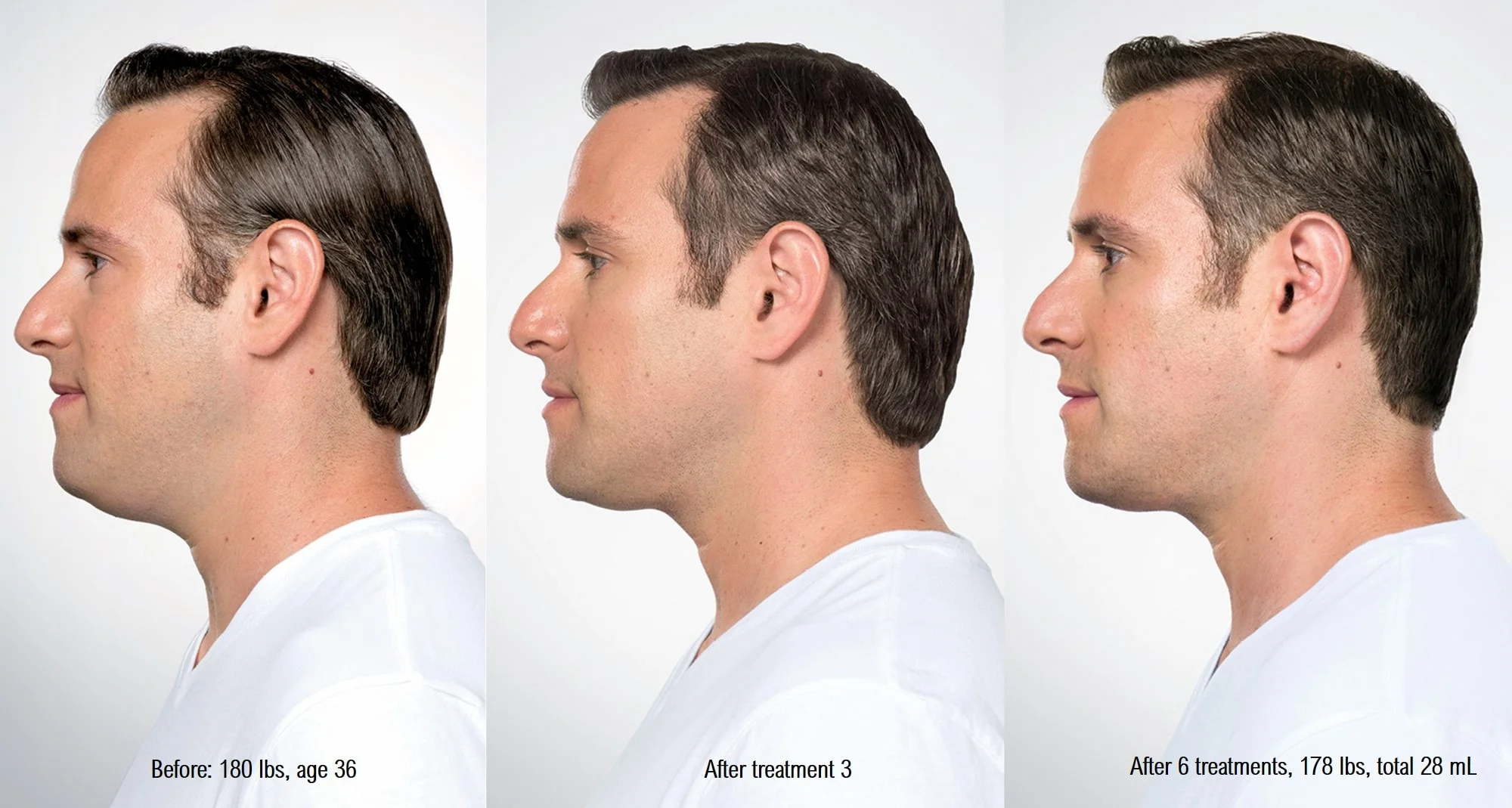 kybella-men-before-after-min.jpg