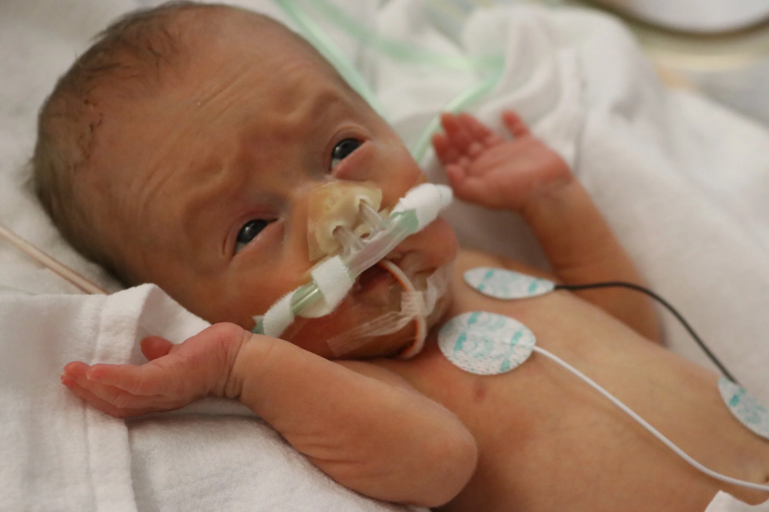 Day 55 - Neurosurgery Scheduled