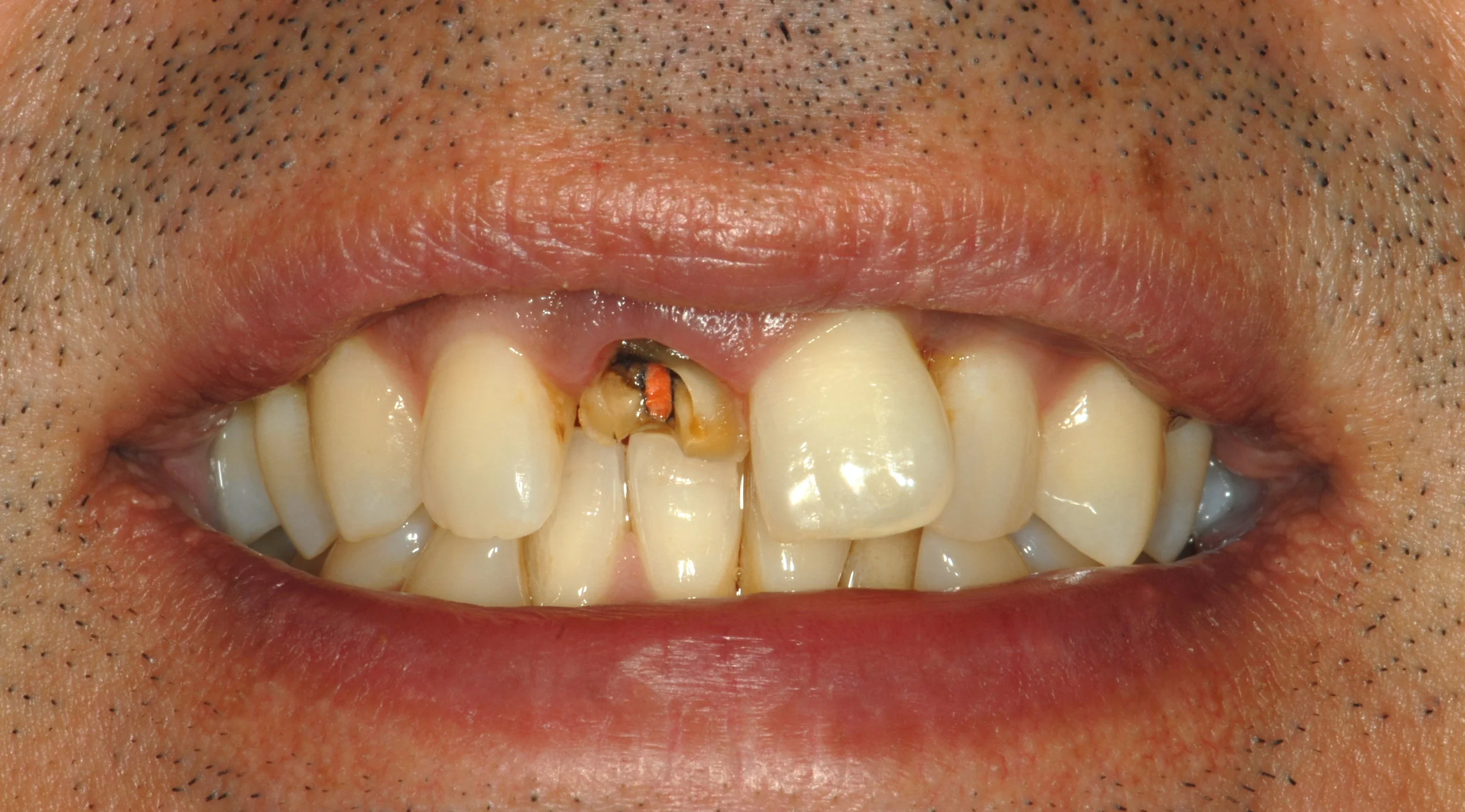 Fractured single teeth old root canal before 