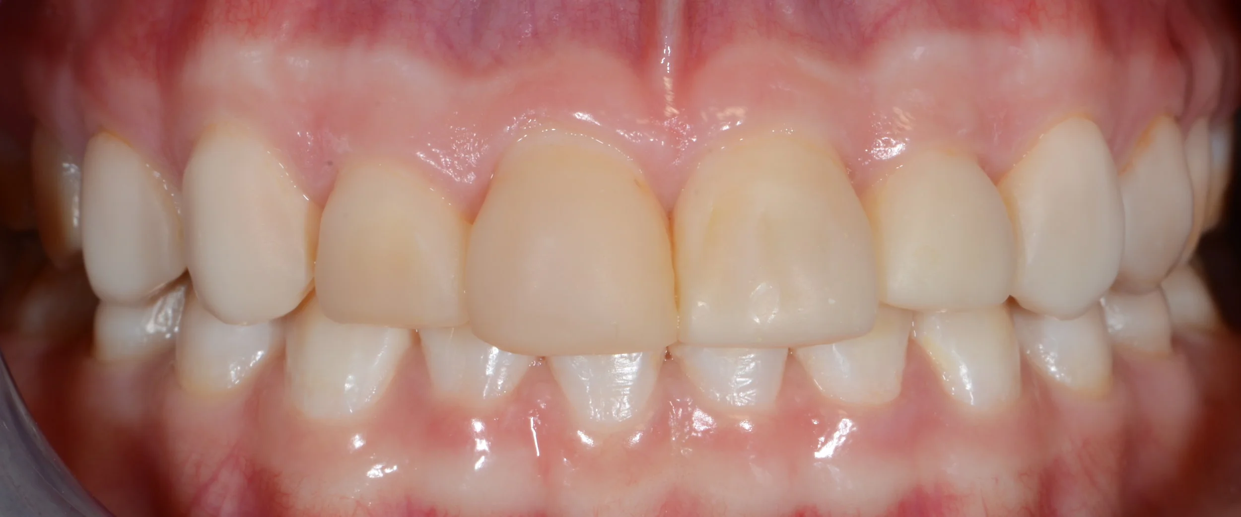 Ill fitting bonding on tetracycline stained teeth before 