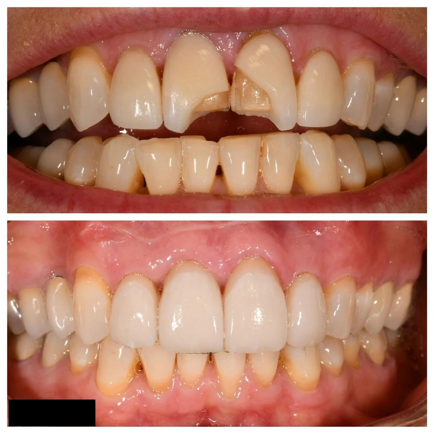 This is a case of olive pit versus 20 year old porcelain jacket crowns&hellip;The olive pit won, but with newer technology we were able to deliver an esthetic result using lithium disilicate, even with long teeth.