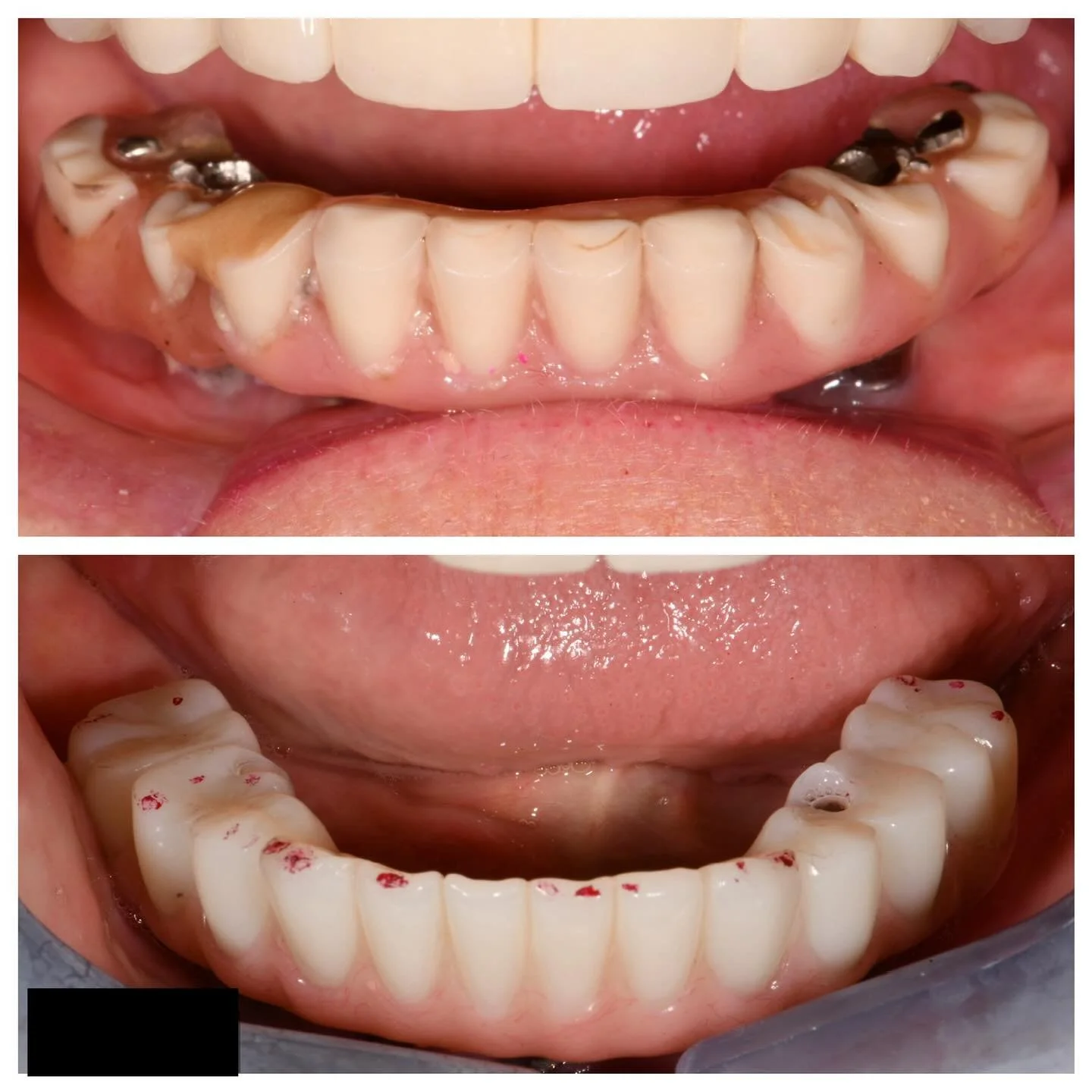 Today&rsquo;s traditional Tuesday post is showcasing conventional metal acrylic hybrid prosthesis rehabilitation. The original prosthesis was over 20 years old and the acrylic was worn. A bite registration was completed at the restored VDO using gc p