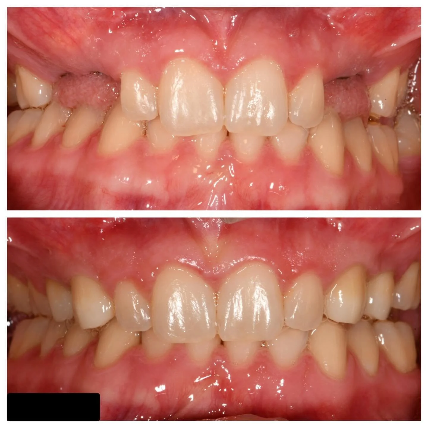 Today is Team Thursday. We are highlighting a multidisciplinary case involving a patient with several congenitally missing permanent teeth. The patient underwent orthodontic treatment followed by implant placement and screw retained Zirconia crowns. 