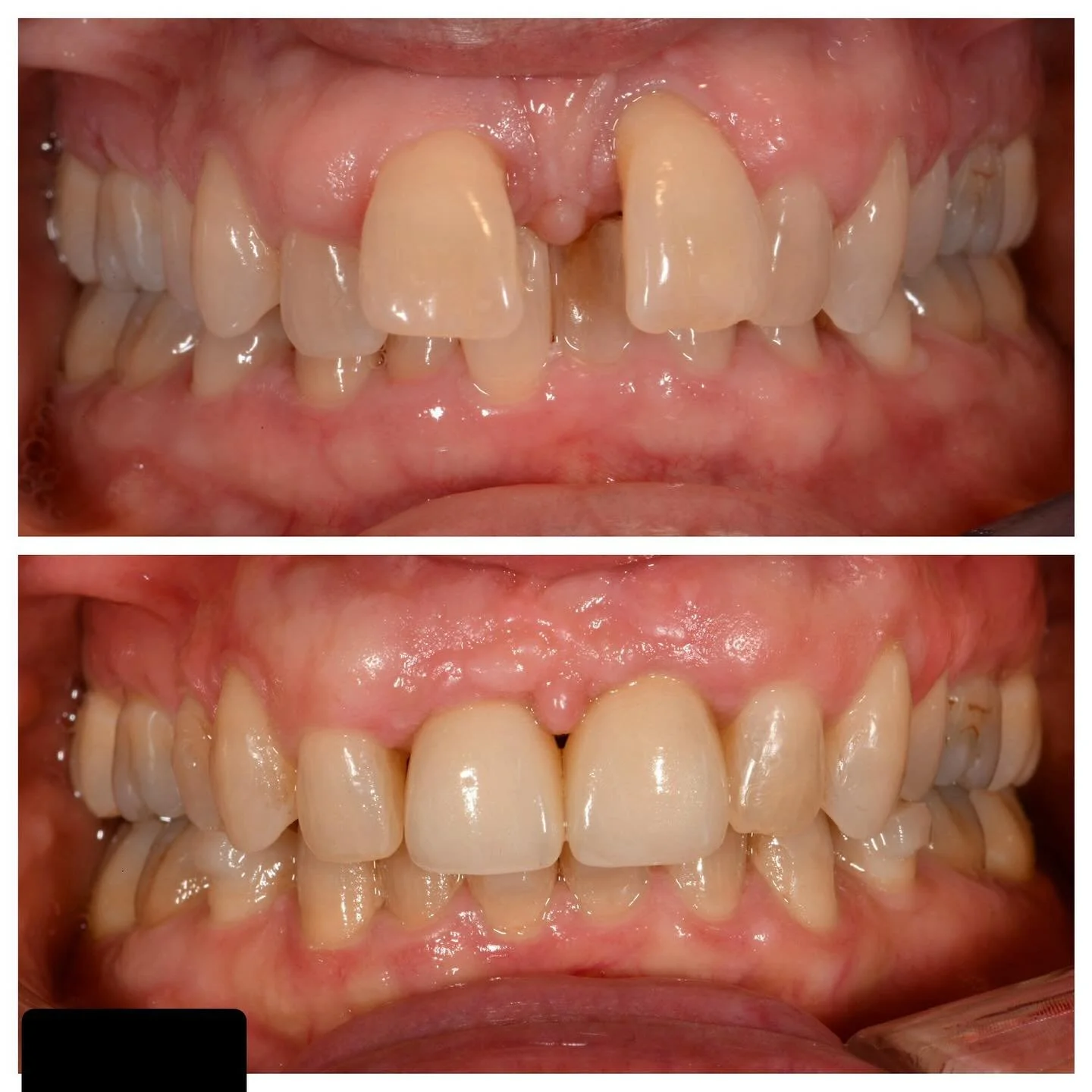 Another Team Thursday case presentation. Multidisciplinary team approach including 2 years of orthodontic treatment followed by implants for teeth #8 and 9. The pictures were taken at a 5 year recall visit. Thanks @shefferman_ortho and @capitalcenter
