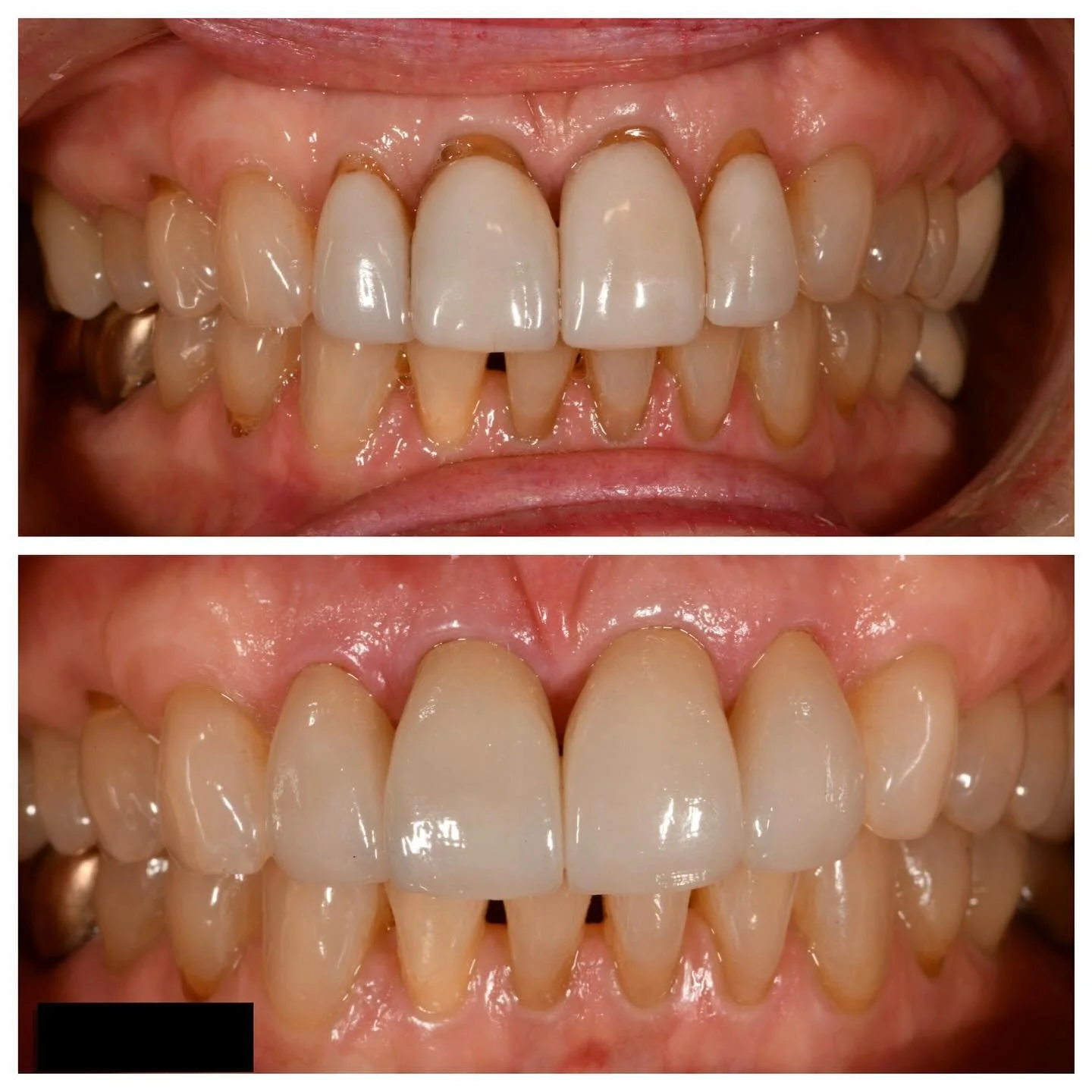 Replacement of twenty year old porcelain jacket crowns with state of the art lithium disilicate crowns. The patient had thin tissue and we were able to make long teeth look natural. She was very happy!