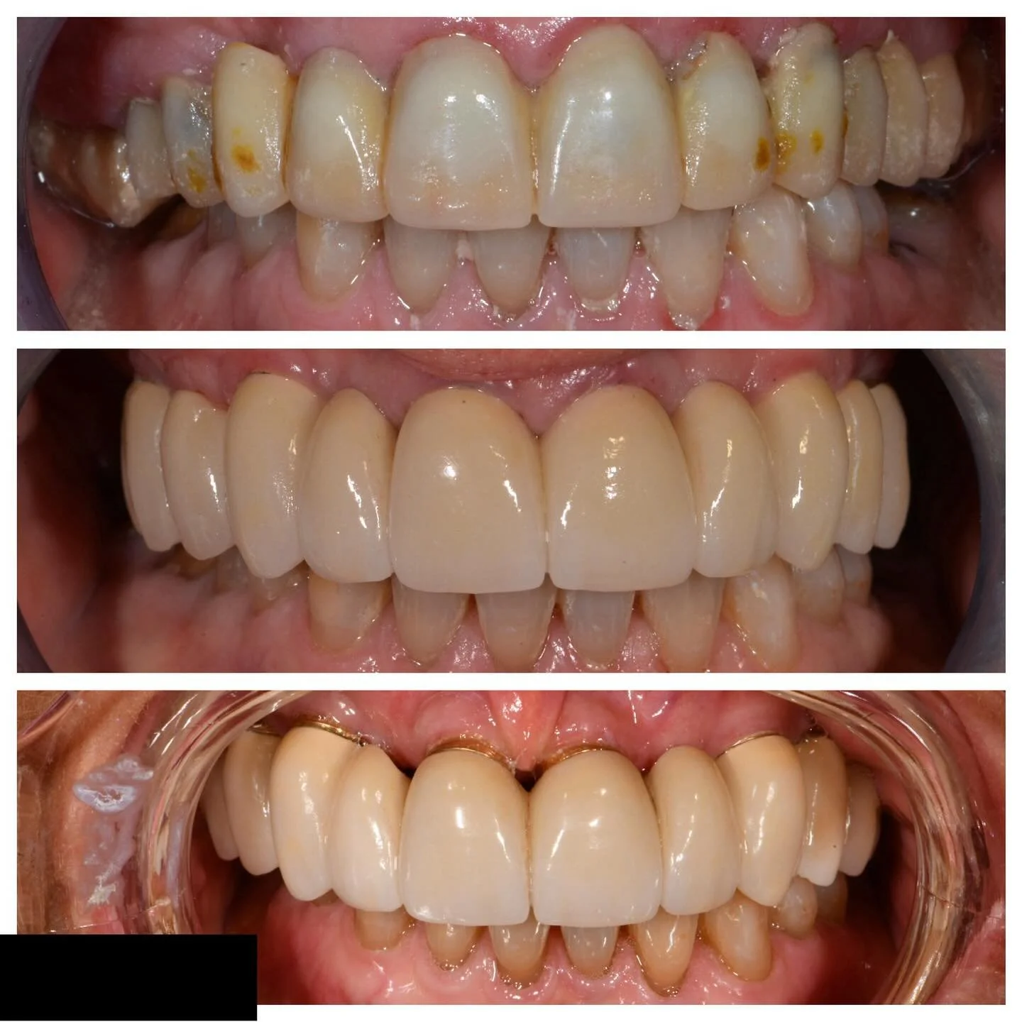 As our patients age, so does their dentistry.
This week, we&rsquo;re highlighting a 15-year follow-up of a patient with a maxillary arch implant reconstruction. Despite some gingival recession, the patient has maintained excellent oral hygiene. The s