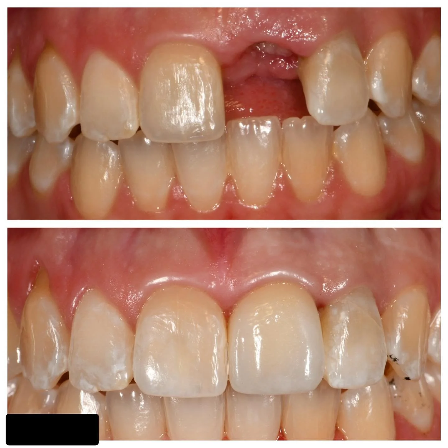 Replacing a single central incisor with an implant is arguably one of the hardest things to do in dentistry. The photos are from a two year follow up. The patient is so happy! Thanks @capitalcenterdc and @rw_emery for a great result