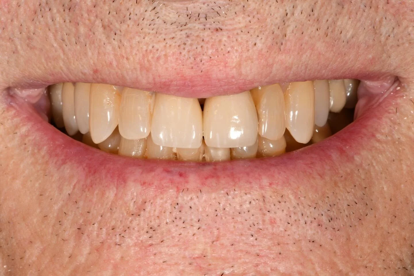 On this traditional Tuesday we are highlighting replacement of a single central incisor with an implant while matching the shade of an existing crown on the other central incisor. The implant was immediately provisionalized to preserve the soft tissu