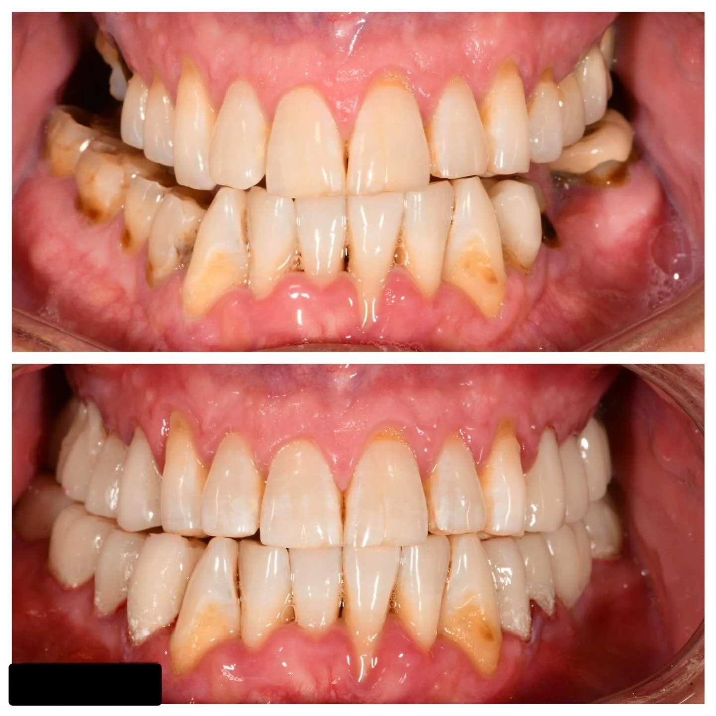 This week&rsquo;s mid-treatment update ✨

Our patient originally came in for an orthognathic surgery consult to correct a severe jaw discrepancy. He was only able to bite on his central incisors, with no posterior occlusion, making everyday chewing n
