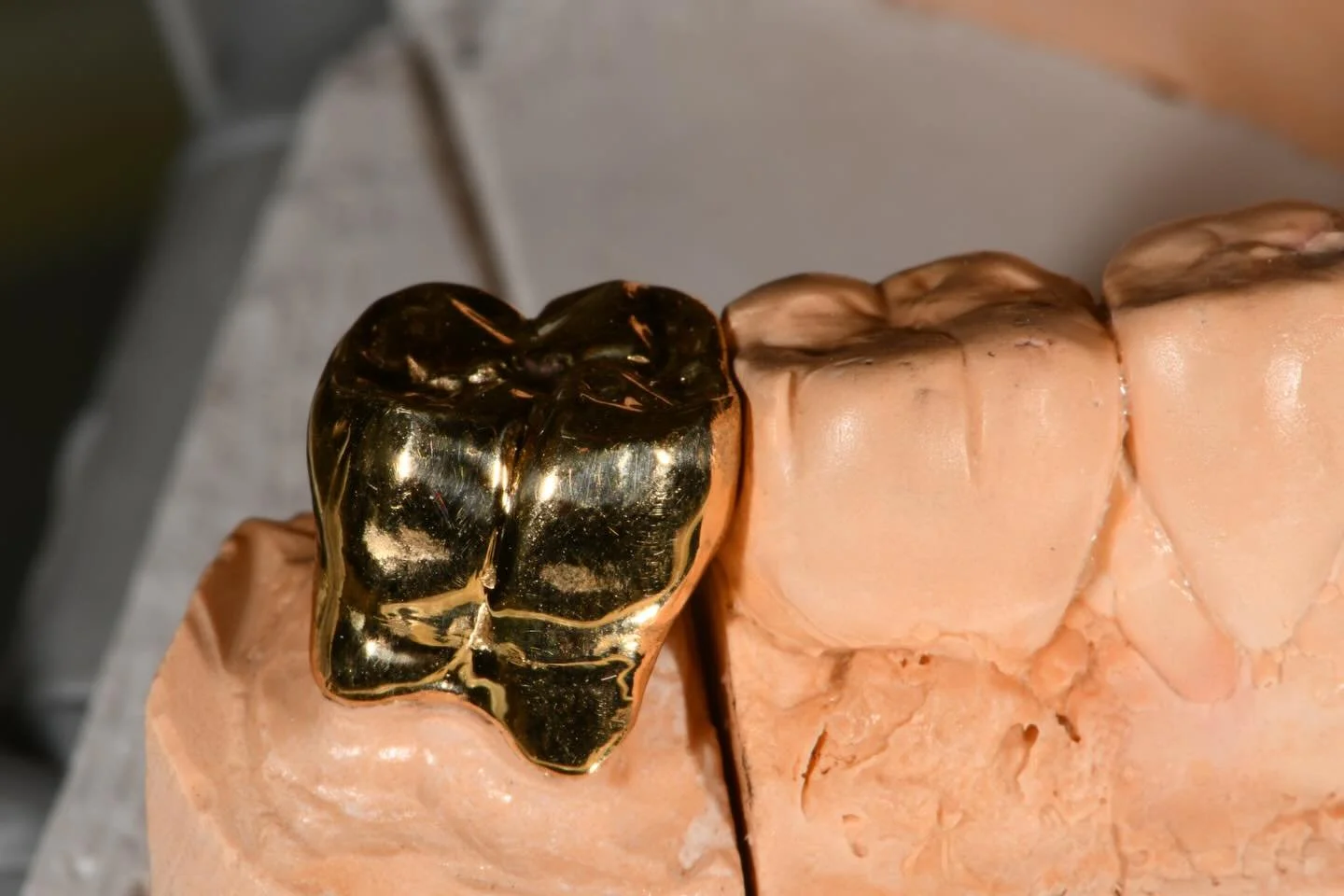 Some may call gold a lost art, but at Team Progebin we&rsquo;re still keeping it very much alive. Check out this Perio-Prosth prep featuring beautifully beveled margins that follow natural root anatomy and clean, barreled furcations.

A classic techn