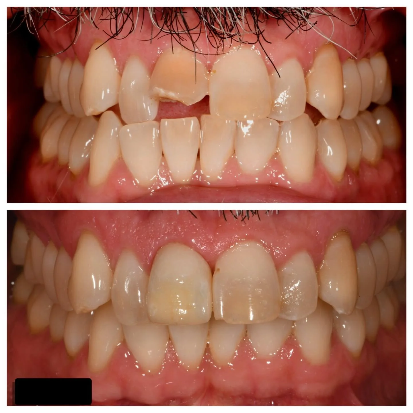 Another single central incisor restoration ✨

Our patient fractured #8, and we restored it with a lithium disilicate all-ceramic restoration. He was thrilled to say goodbye to his &ldquo;snaggle tooth&rdquo; and hello to a natural, seamless smile 😁
