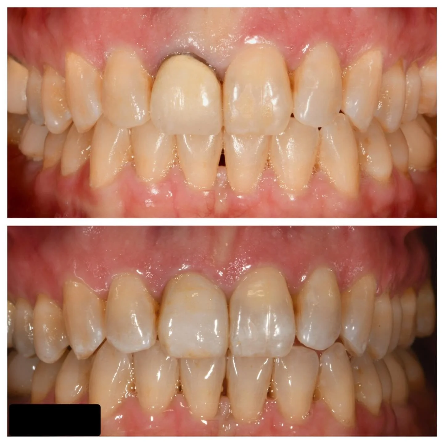 Happy 2026! ✨
We&rsquo;re starting the year with one of the toughest challenges in dentistry&hellip;restoring a single central incisor. Matching the shade and character of a natural adjacent tooth is no easy task, but teamwork makes all the differenc