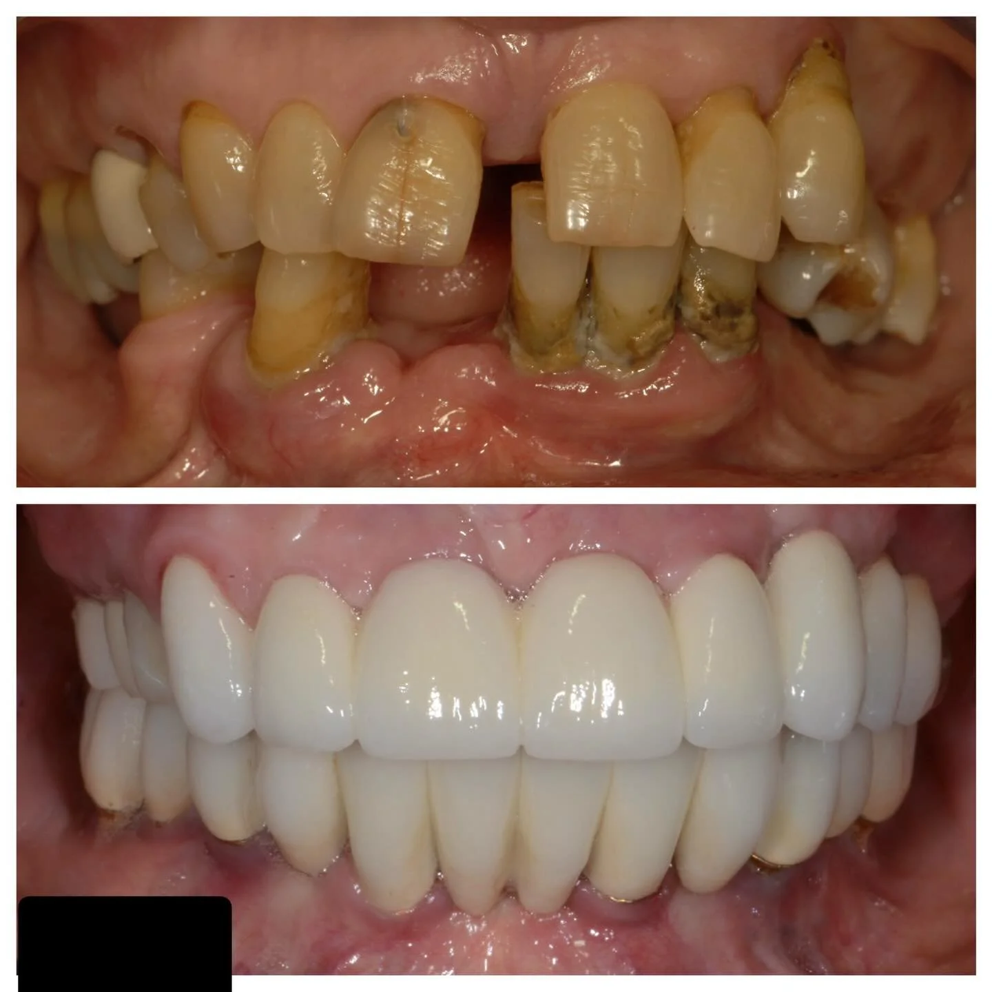 Patient presented with advanced periodontal disease and a hopeless dentition. A full-mouth rehabilitation was completed, and 15 years later the patient remains stable, healthy, and smiling! Thanks @capitalcenterdc for the great team effort!