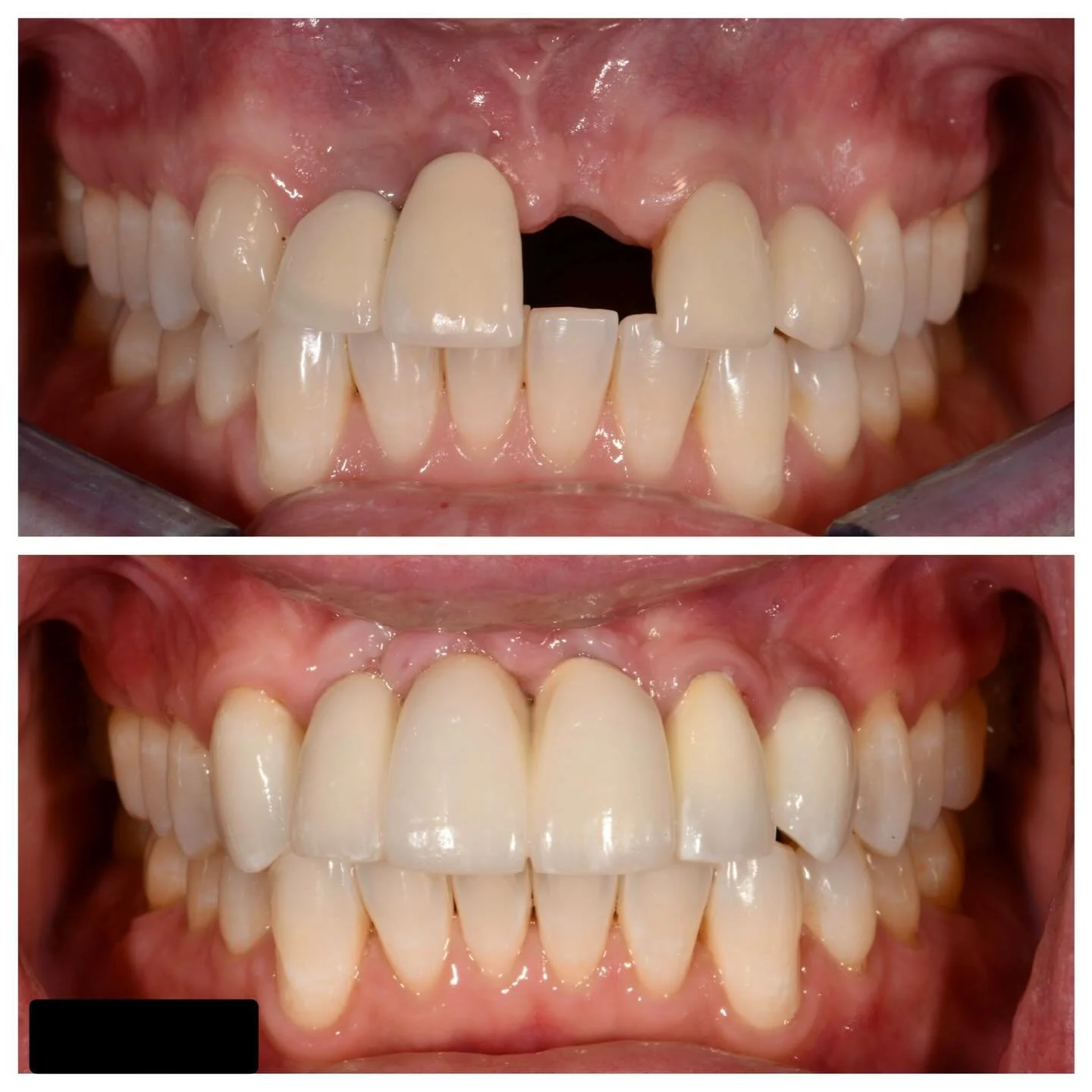 Challenging case with a rewarding outcome. This patient presented after a failed implant treatment completed by a different provider and required revision surgery followed by a new round of implant therapy. This photo is from the 5-year follow-up. Th