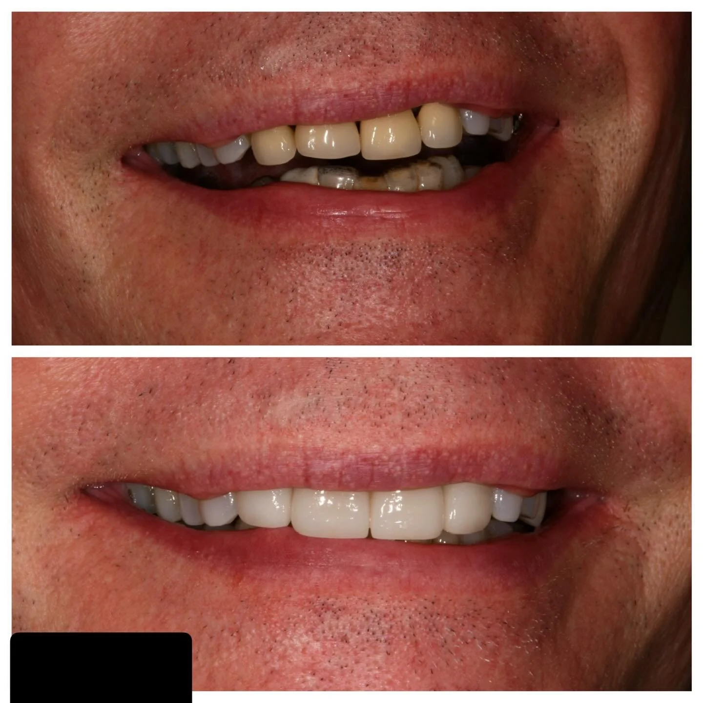 Hope everyone is staying warm and enjoying the snow! ❄️ This week&rsquo;s Traditional Tuesday feature highlights a classic perio&ndash;prostho case. The patient presented with existing PFM restorations on teeth 7&ndash;10 and gingival recession. Peri