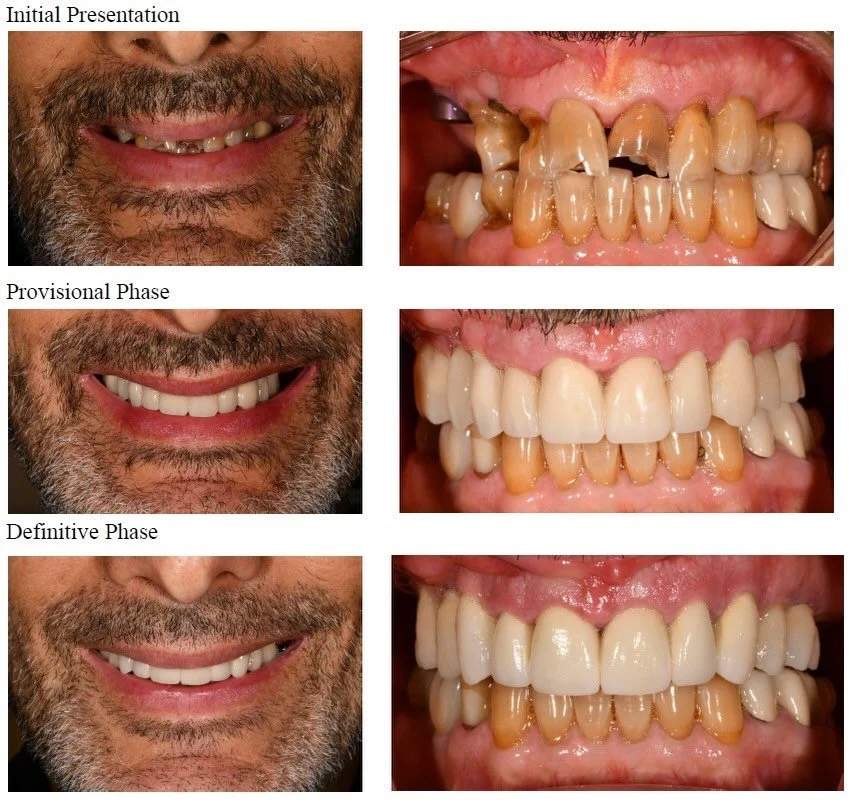 On this Traditional Tuesday, we&rsquo;re sharing a multidisciplinary case involving periodontics, prosthodontics, and oral surgery.

After initial therapy, implant placement, and periodontal crown lengthening, the definitive PFM crowns were delivered