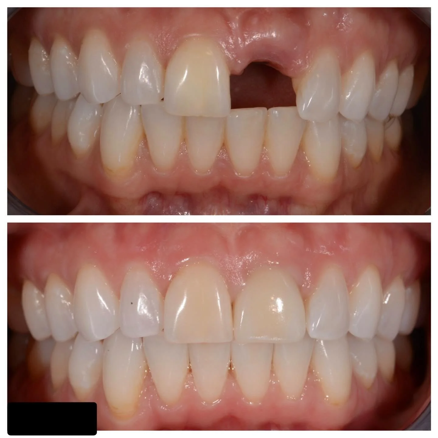 Another Traditional Tuesday spotlighting our incredible laboratory partners 👏

Replacing a single central incisor is always a challenge&mdash;especially when the adjacent central has multiple shades and subtle characterizations. Achieving a seamless