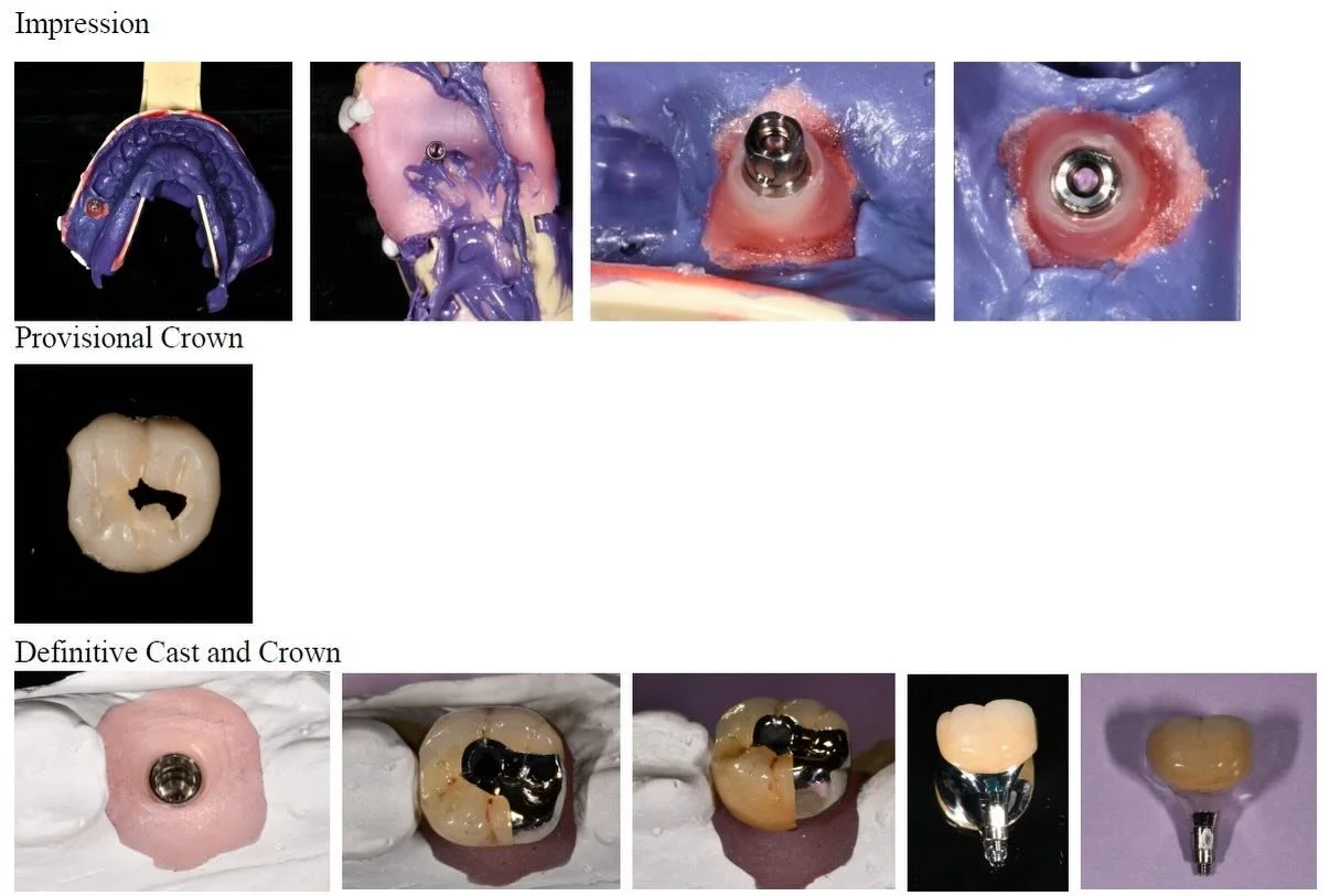 On this Traditional Tuesday, we&rsquo;re highlighting a classic Washingtonian, stressed grinding, who wore a hole through their provisional crown.

We anticipated heavy occlusal forces from the start, so metal occlusion was incorporated into the trea