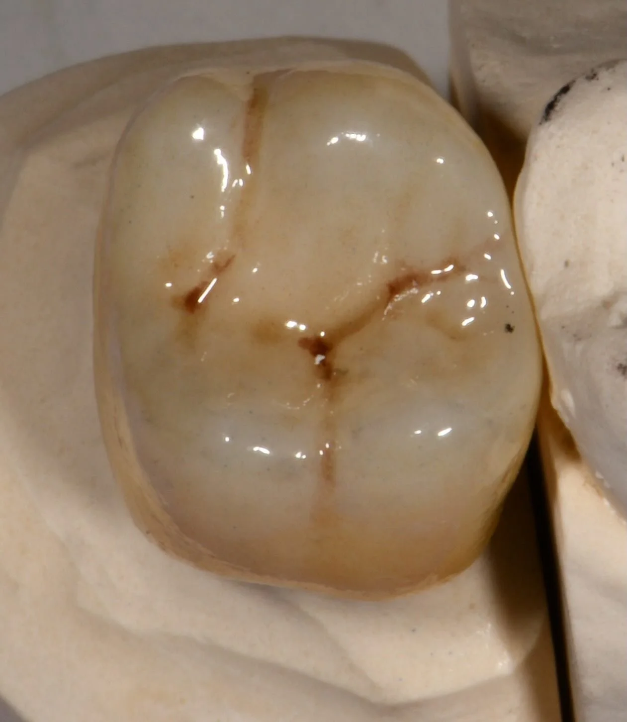 On this Traditional Tuesday, we&rsquo;re showcasing the perfect blend of classic time tested prosthodontics featuring bevel preparations with retention grooves and stone casts&mdash;and modern innovation with a custom stained zirconia crown. Where tr