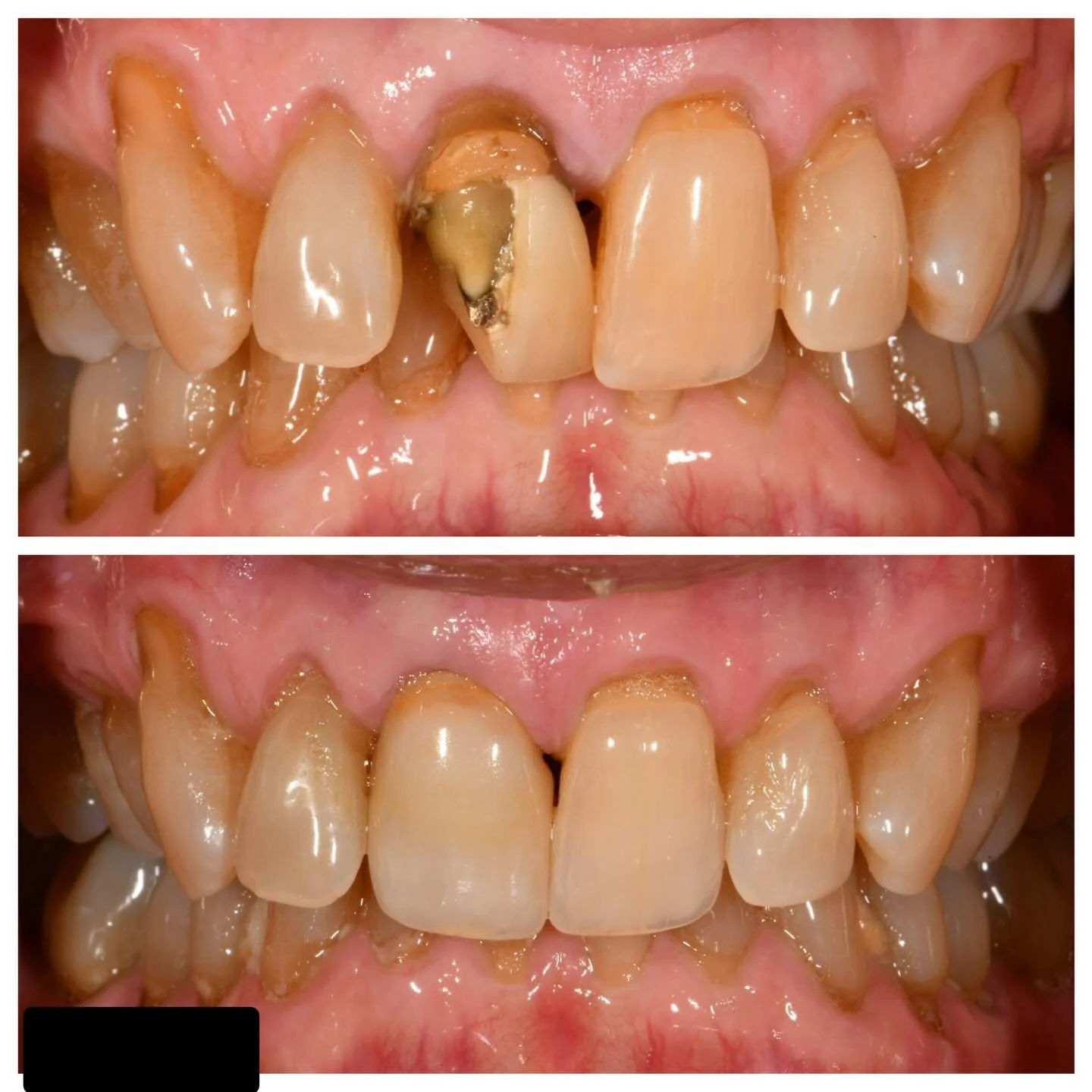 The dreaded single central incisor. 🎯
Our patient fractured a 50-year-old porcelain jacket crown and needed a seamless update. We replaced #8 with a high-translucency Lithium Disilicate crown, focusing on matching the complex characterization of the