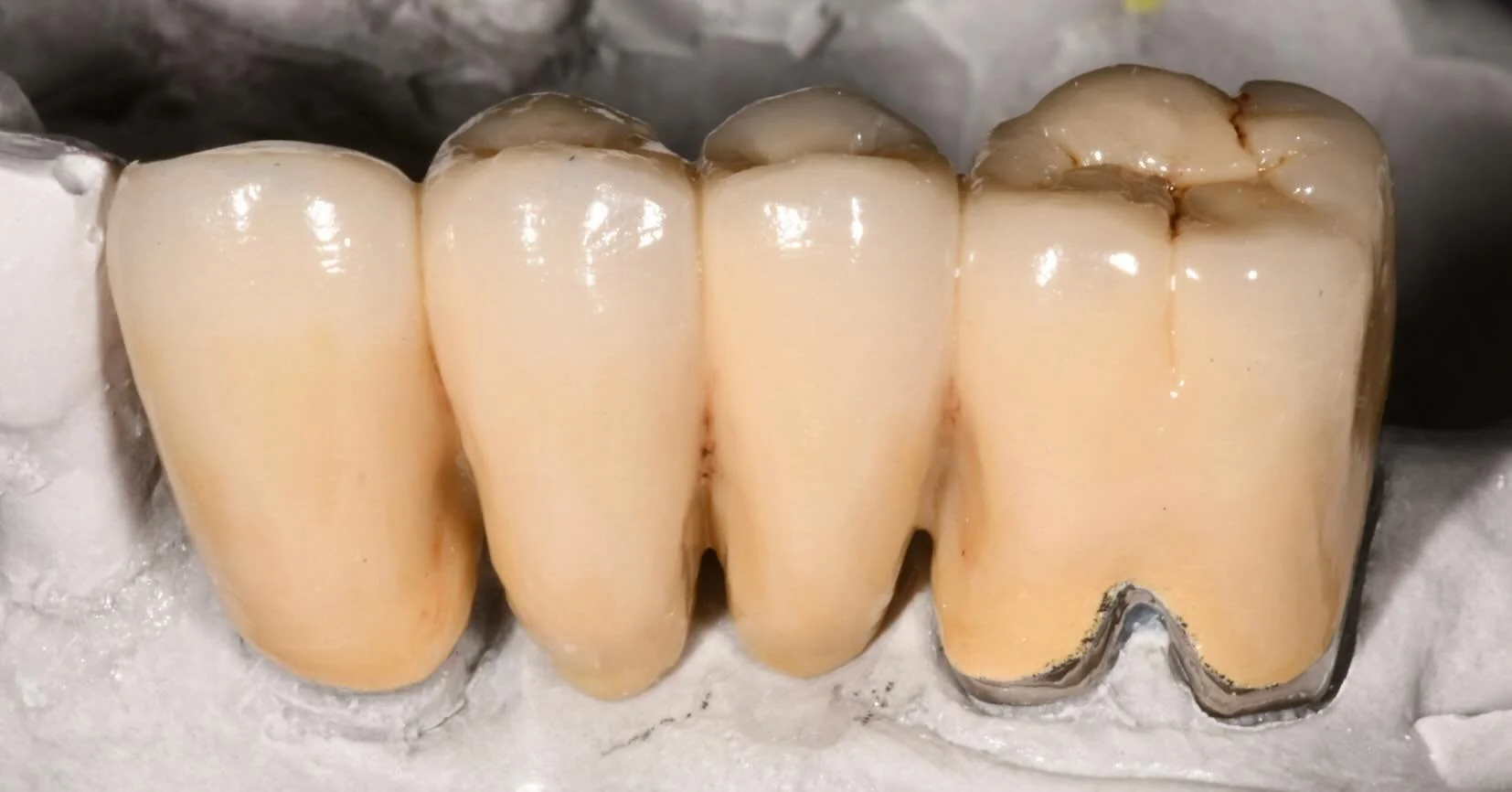 Sometimes old school is still the best.

This patient preferred to avoid implant surgery, so we fabricated a conventional fixed partial denture instead. PFM restorations, beveling, barreled-out furcations &mdash; classic perio-prosth principles that 