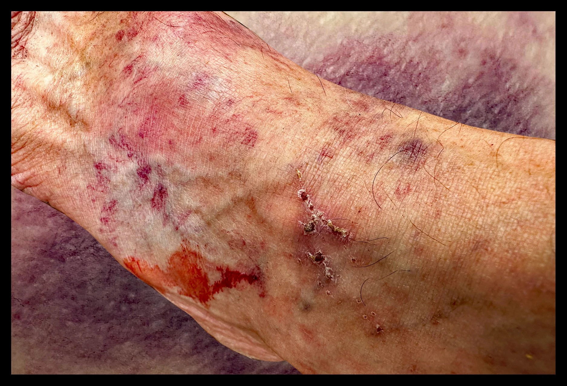 Ankle and bruise