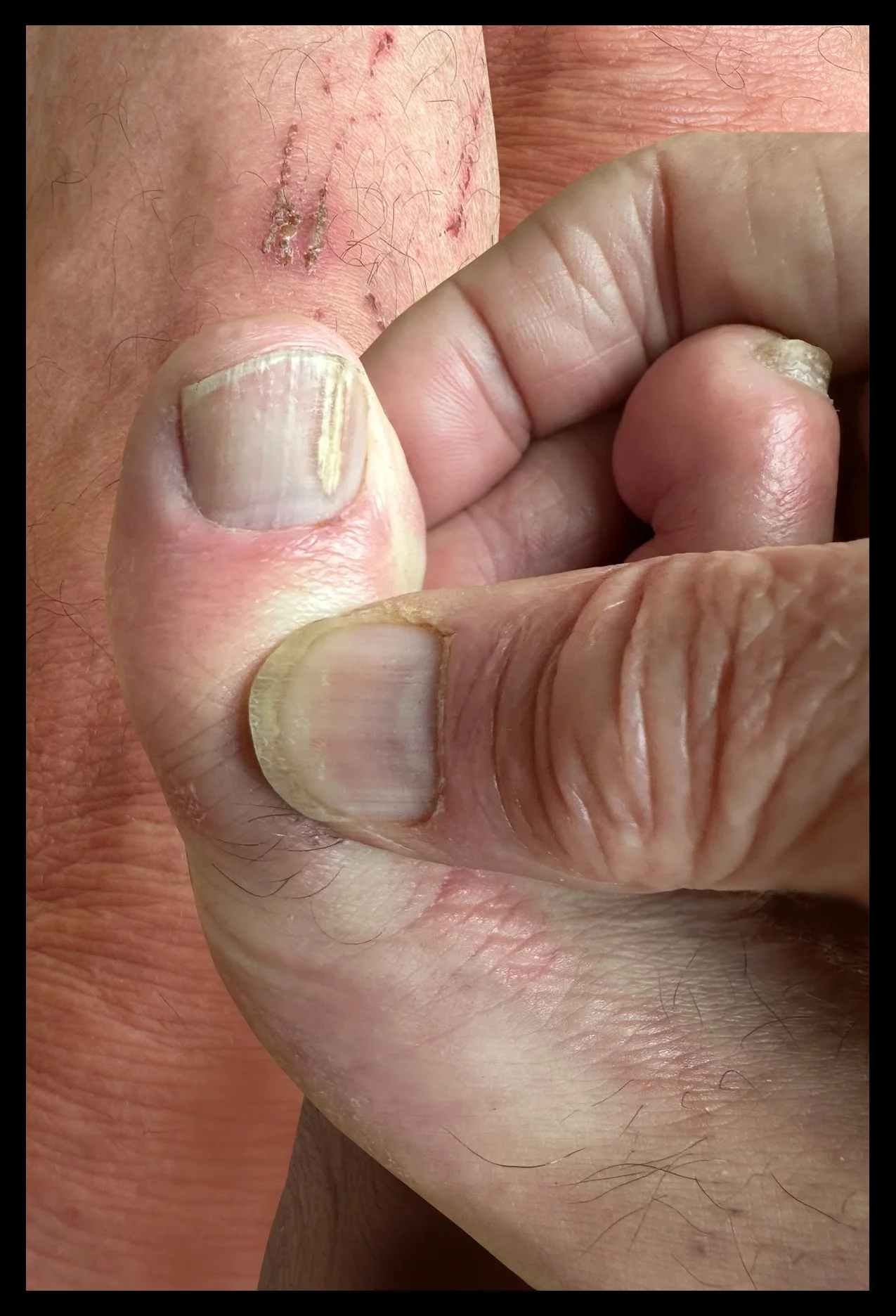 hand and toe raw
