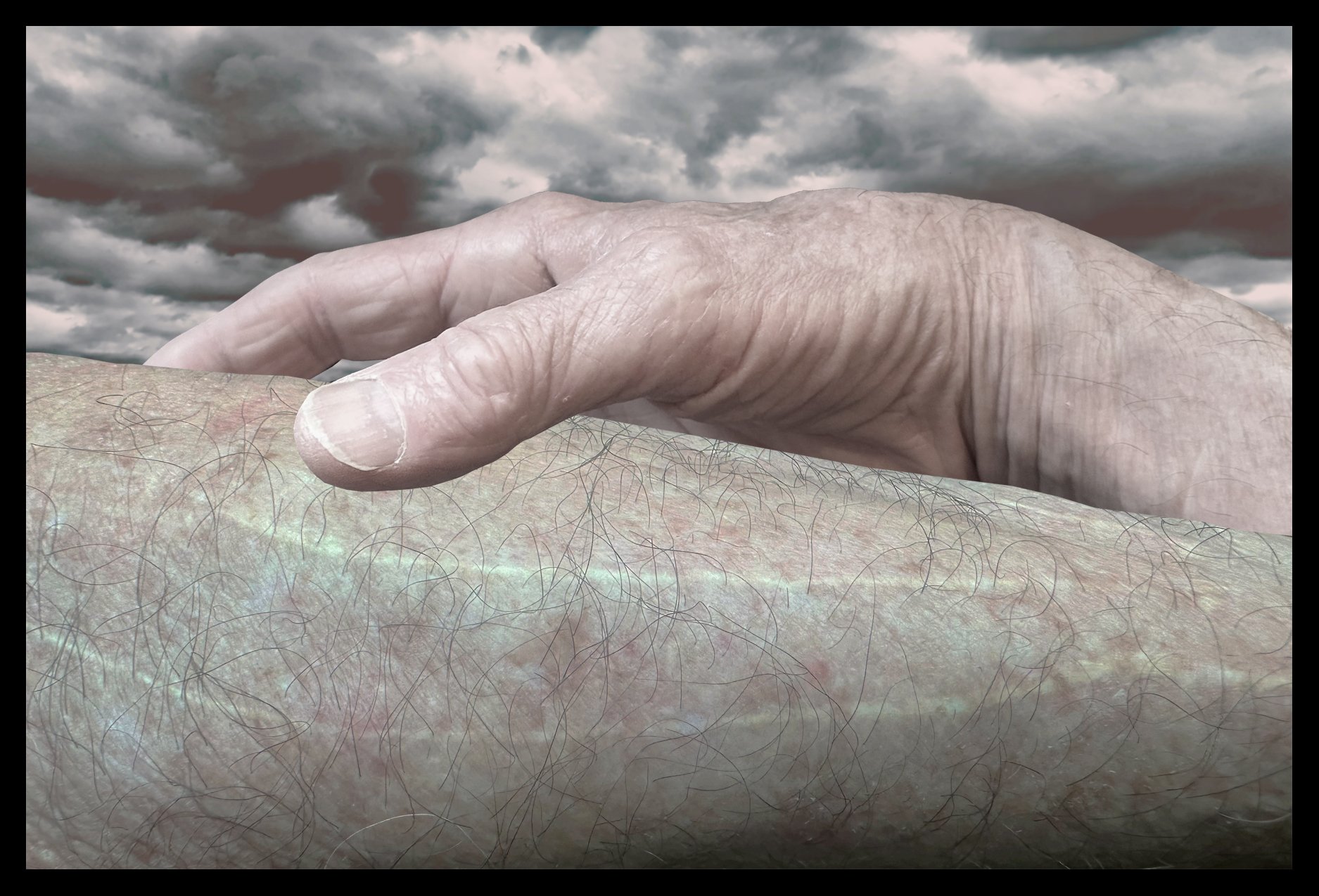 Scars On Arms