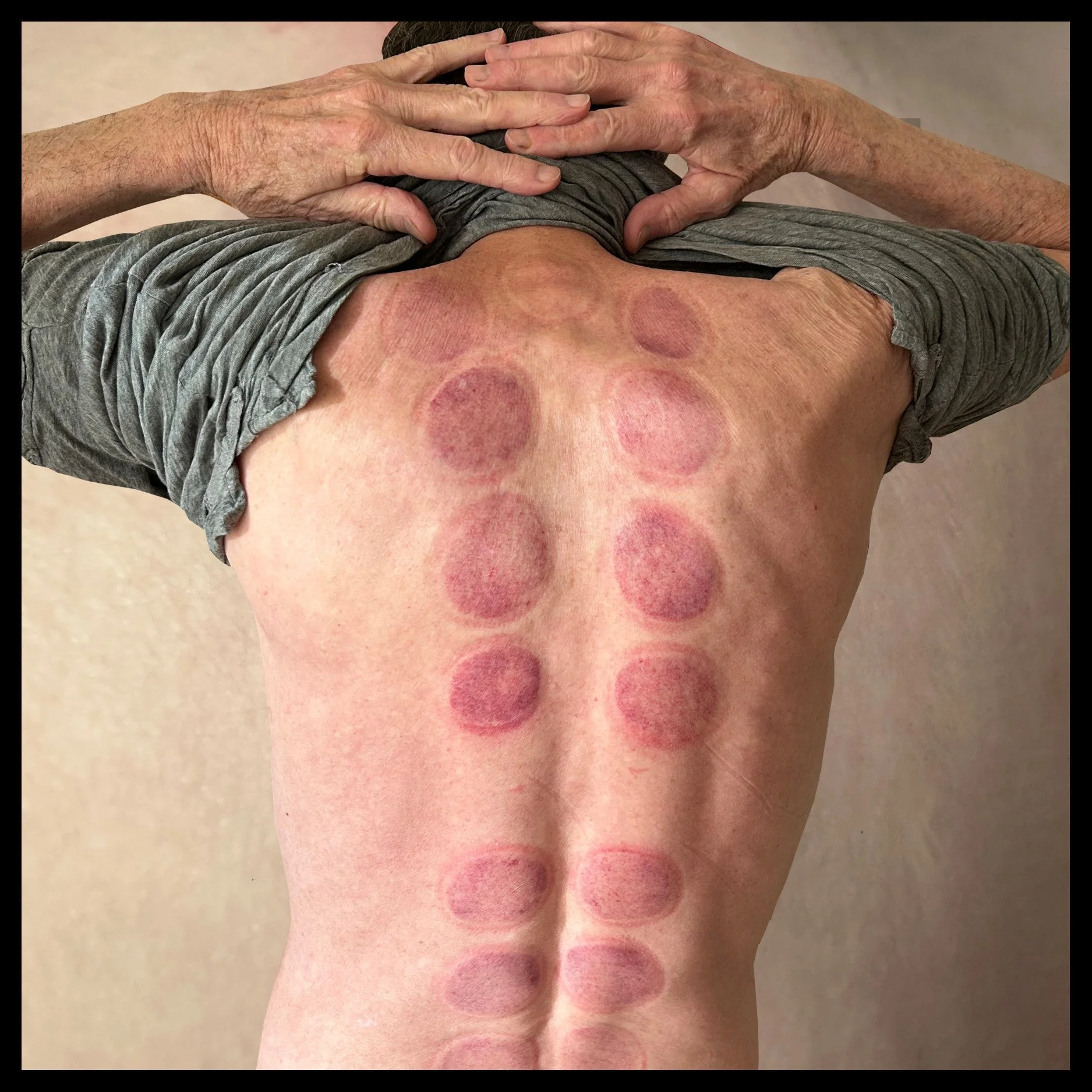 Cupped