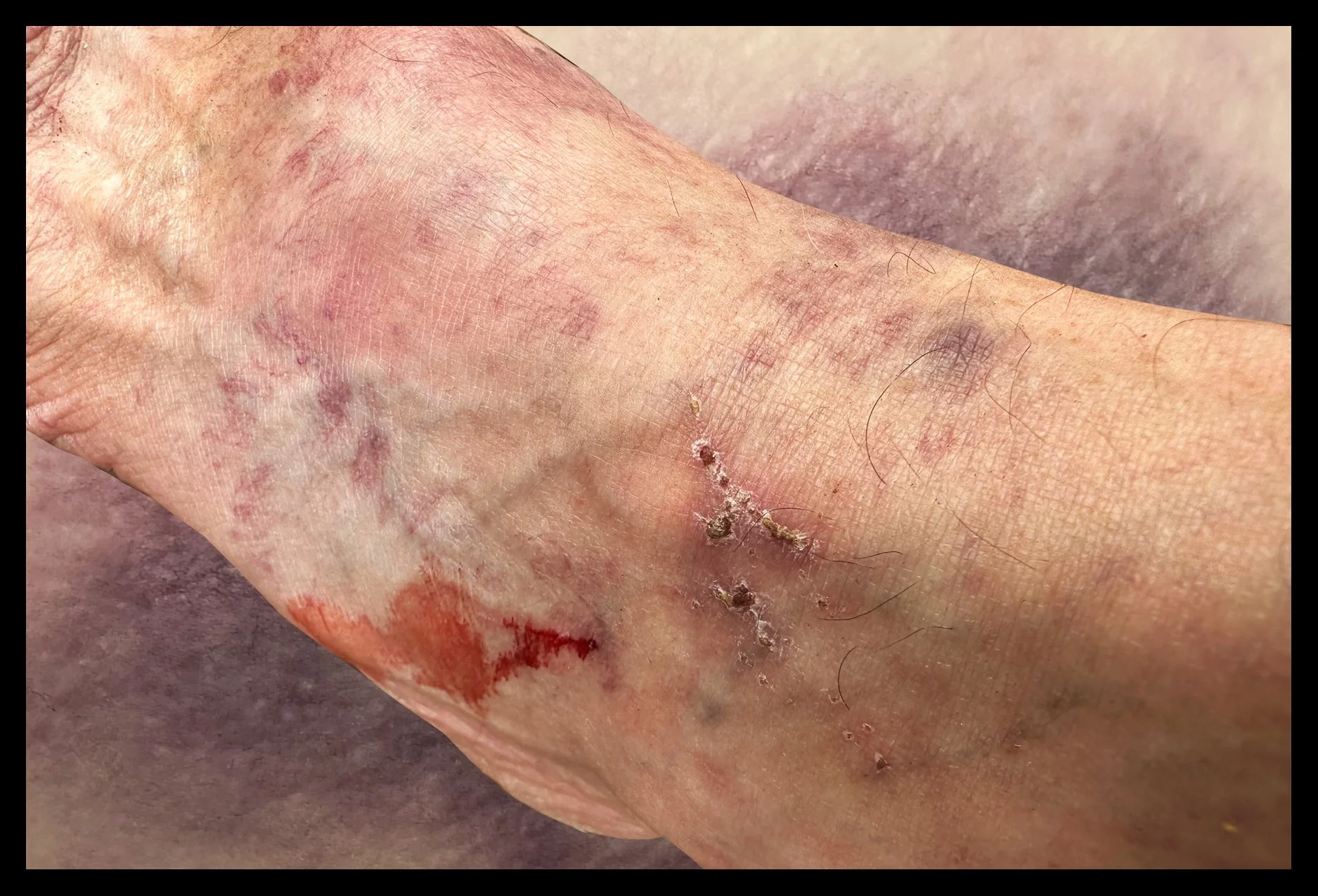 Ankle and bruise