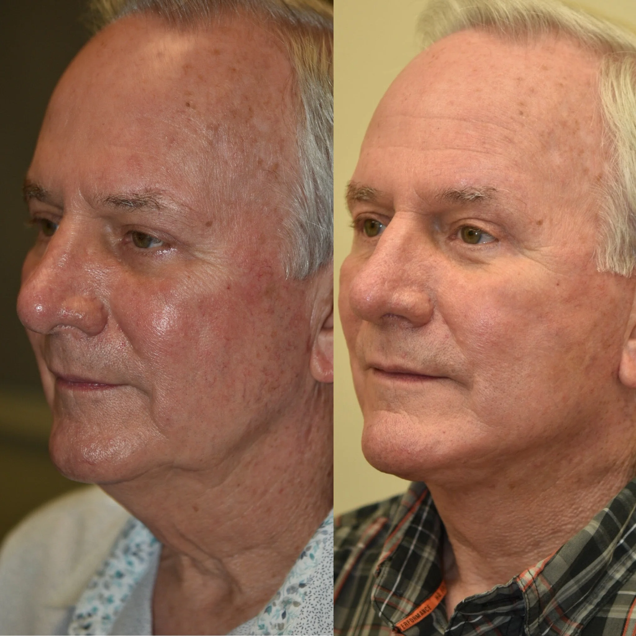Lower Face and Neck Lift, Platysmaplasty, Neck Liposuction