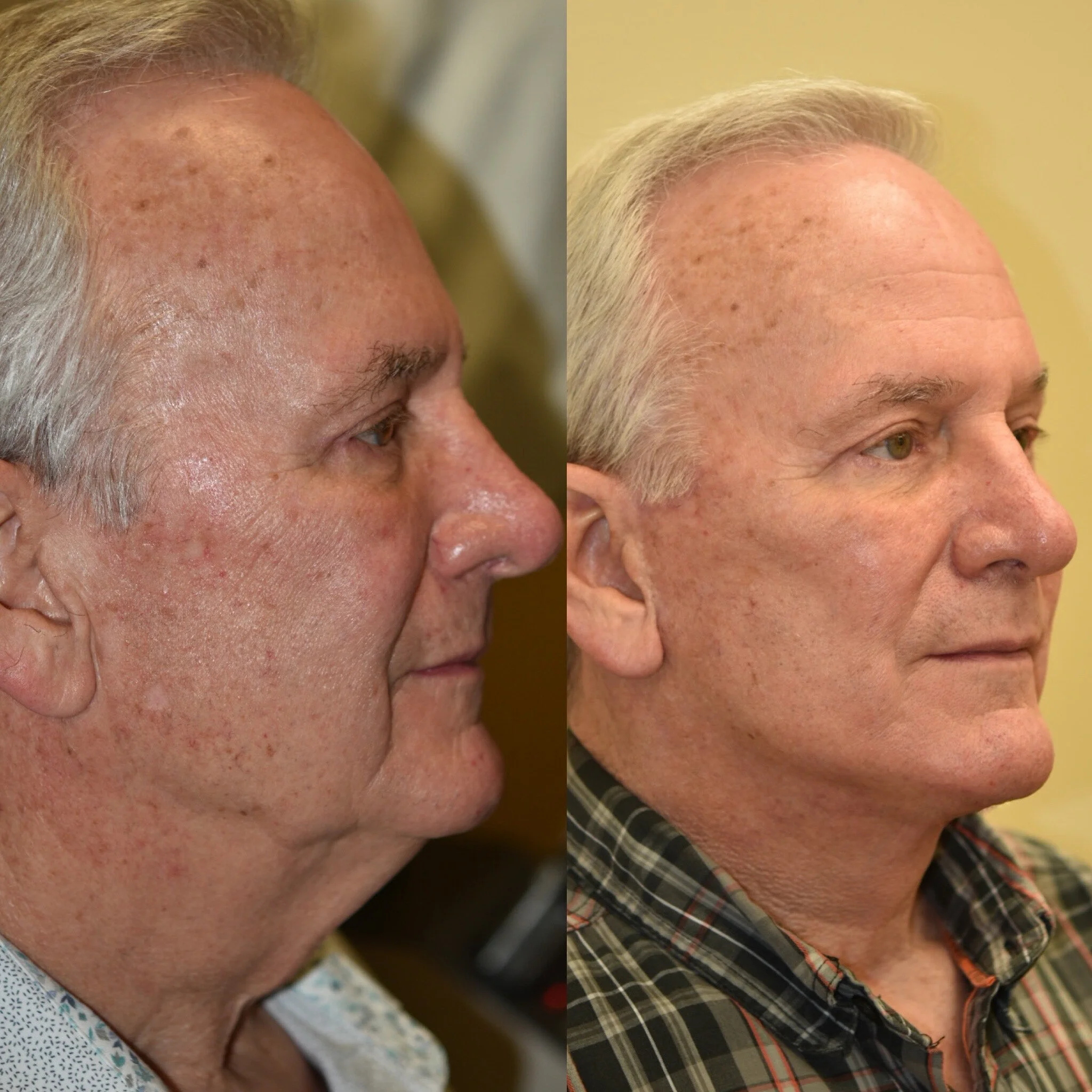 Lower Face and Neck Lift, Platysmaplasty, Neck Liposuction
