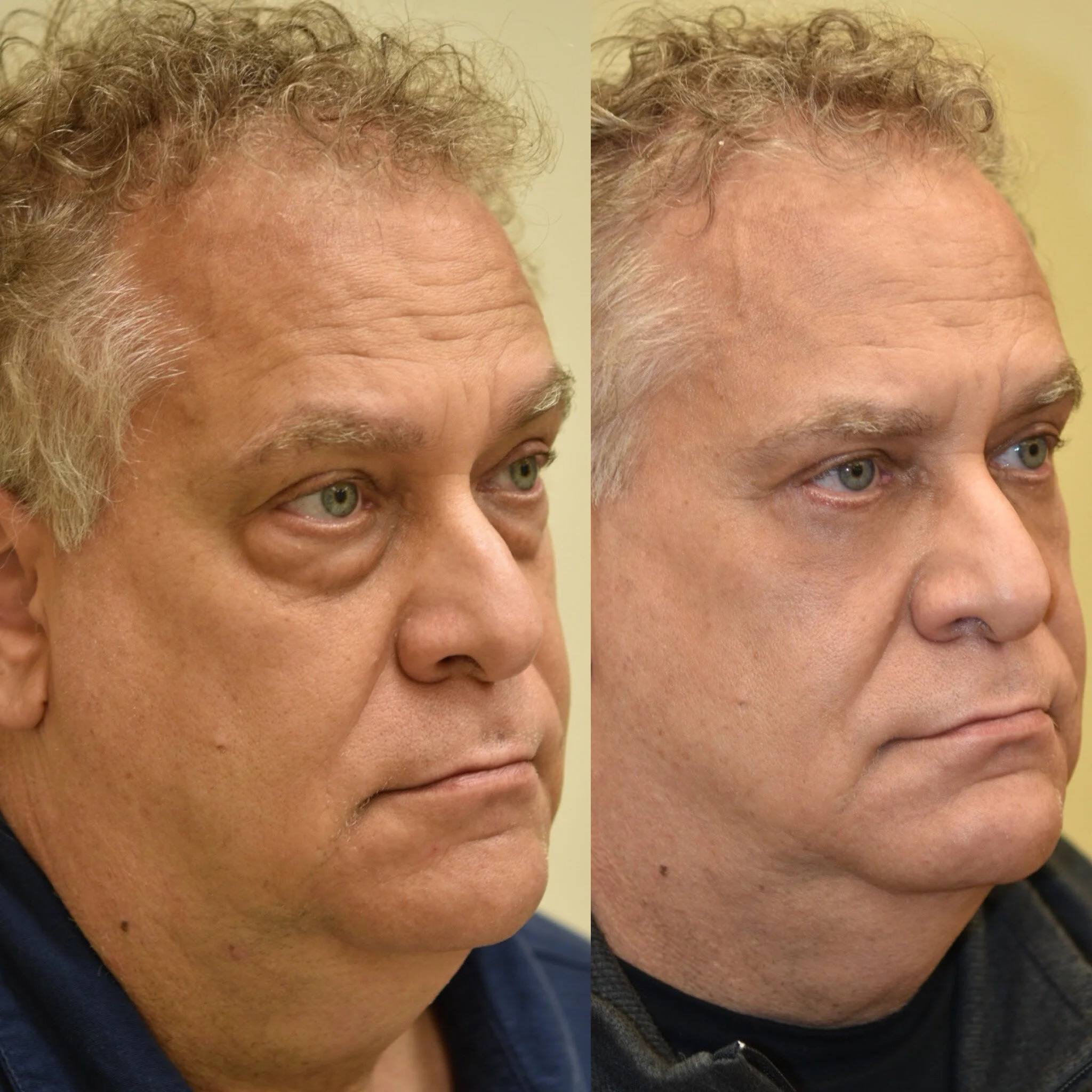 Lower Blepharoplasty with Fat Repositioning and Skin Pinch