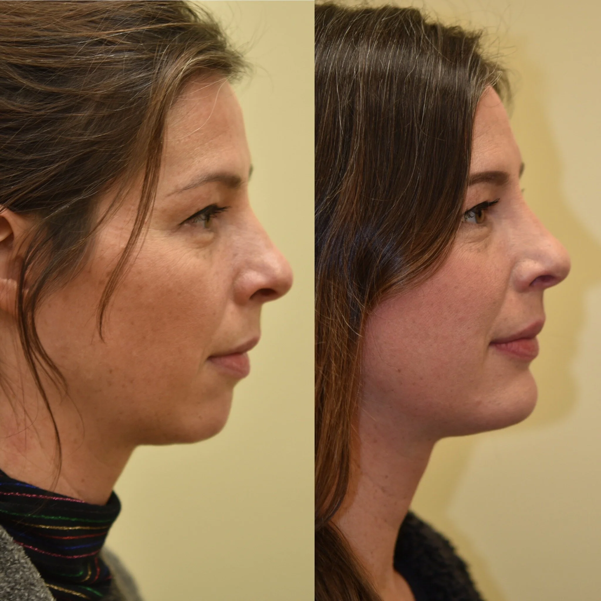 Mentoplasty (Chin Implant)