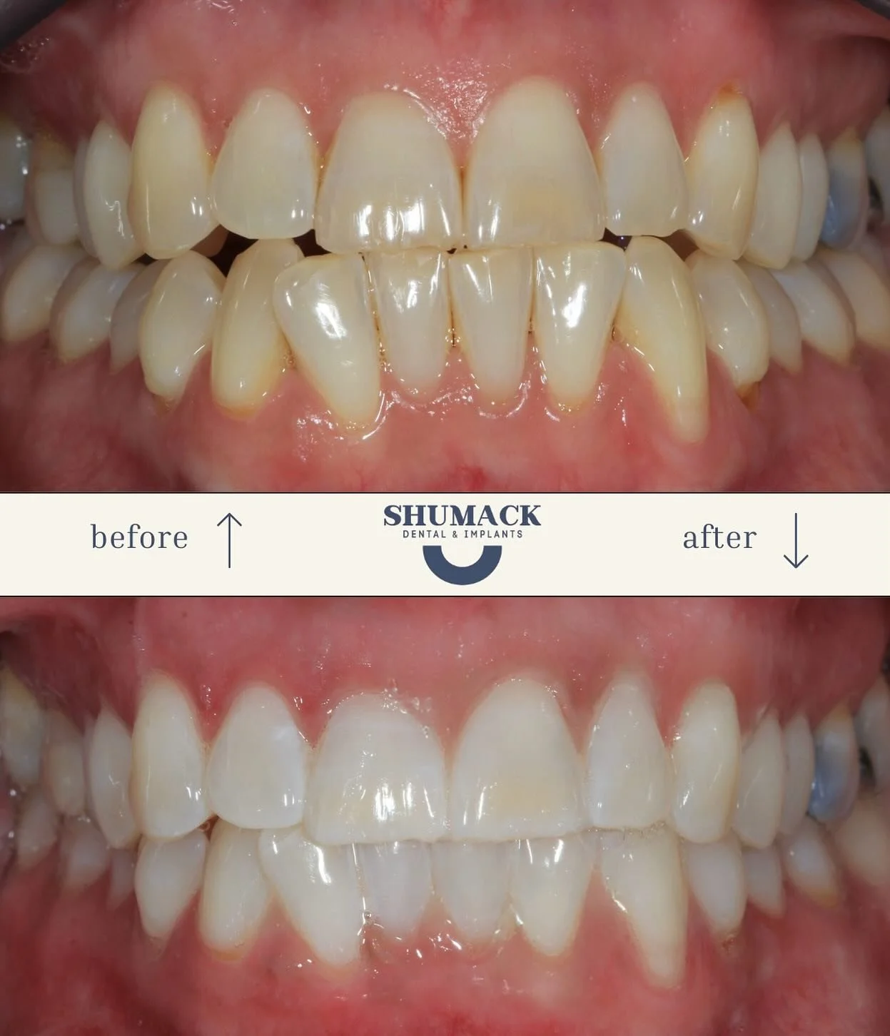 Check out these stunning before &amp; after from our in-chair whitening treatment. Brighten up your smile in just one visit! Ready to glow? Call up today to book yourself a consultation and find out more 😁 
#TeethWhitening #SmileTransformation #Befo