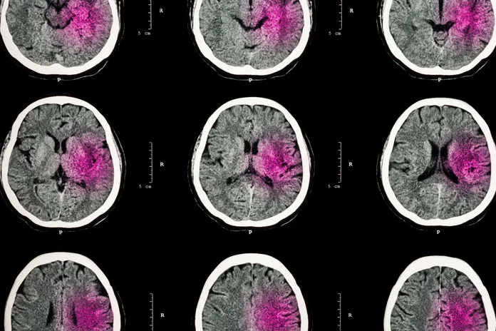 Strokes Are the Third Leading Cause of Death for Women | InStyle