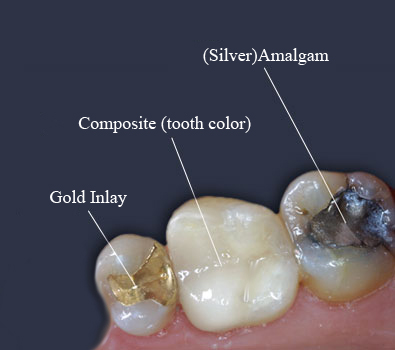 Filling-types.jpg