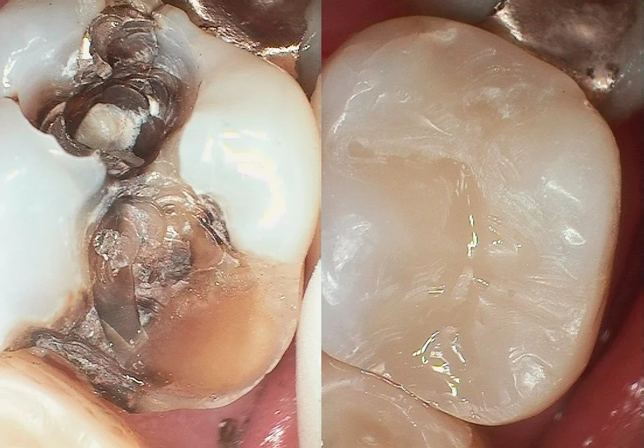 amalgam-to-white1.jpg