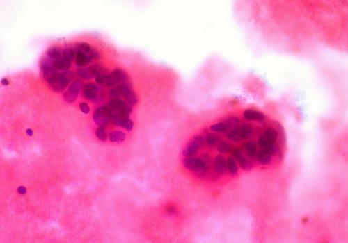 Breast_cancer_metastic_cells.jpg