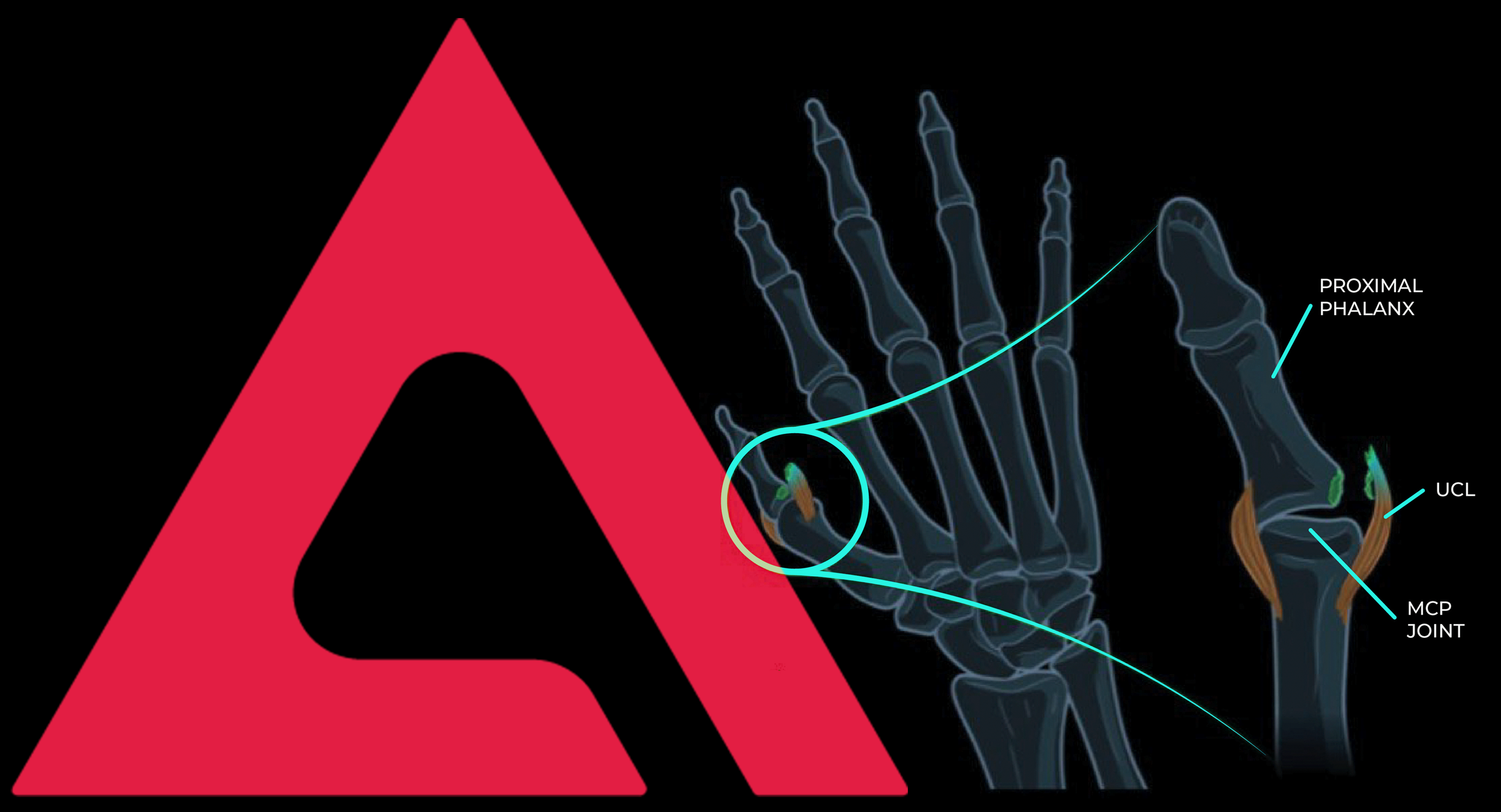 Skier’s Thumb Under Pressure: Achieving Stable Fixation in the Smallest Bones