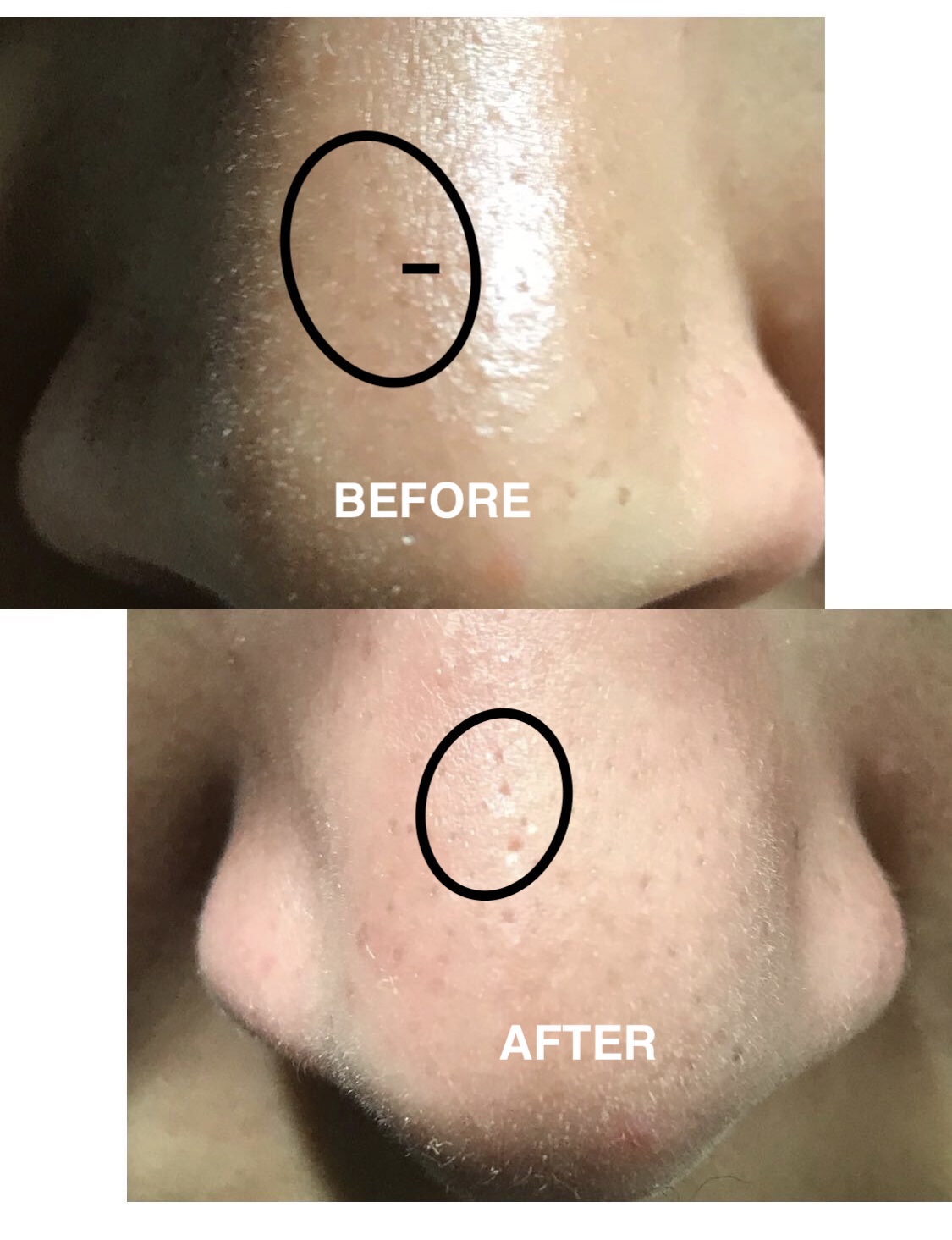 the ordinary blackheads before and after