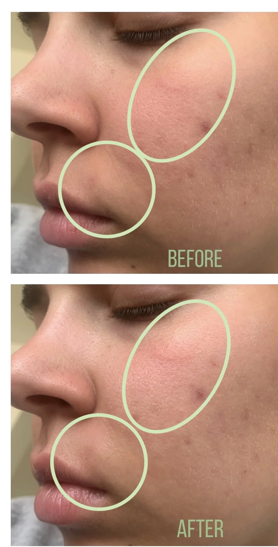 some by mi acne serum